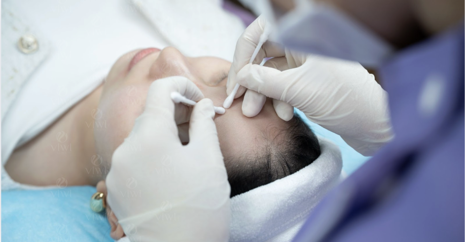 Lấy mụn chuyên sâu