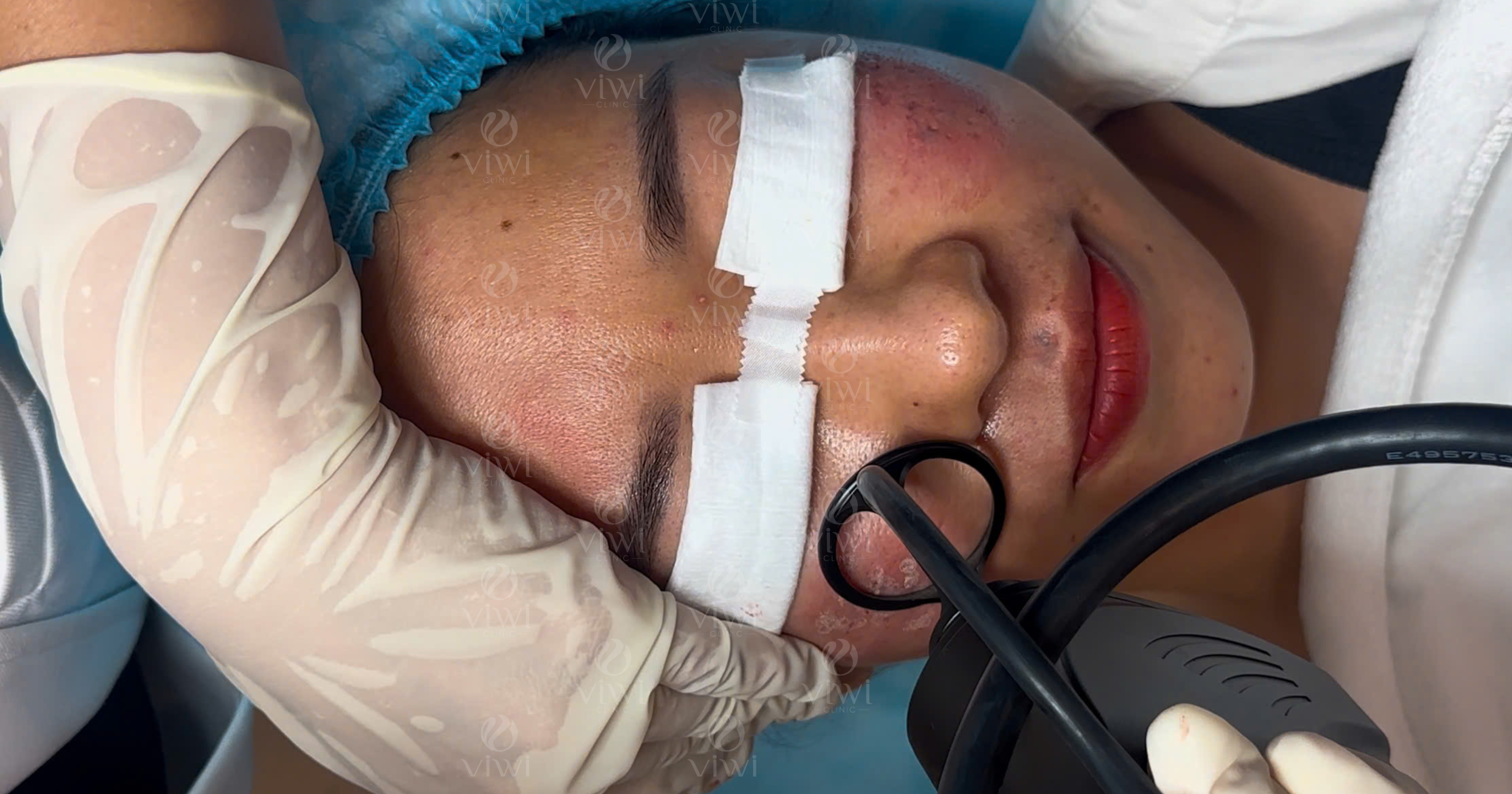 Laser CO2 phân đoạn