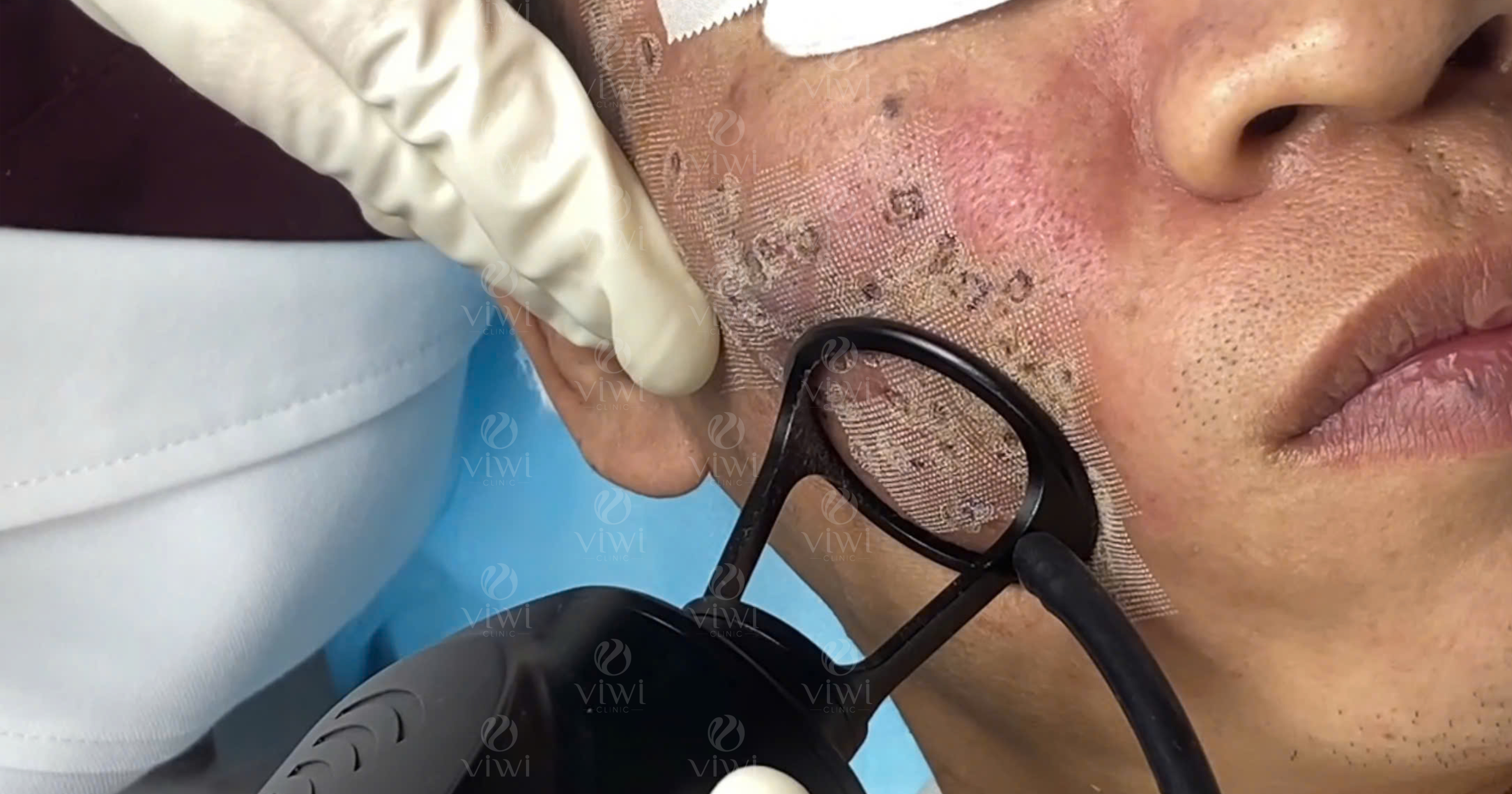 Laser CO2 phân đoạn