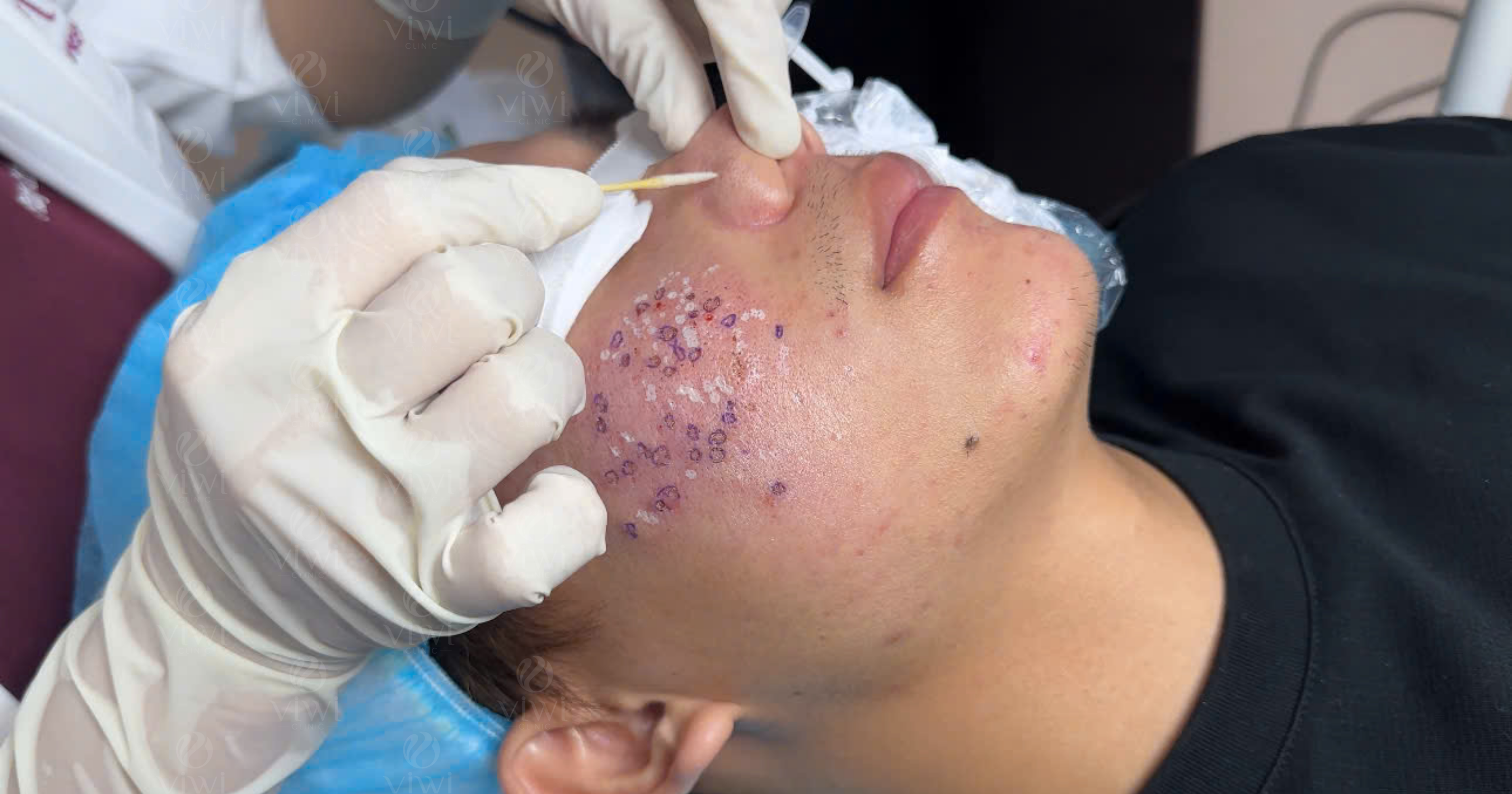 sẹo rỗ lâu nămTCA Cross Peel