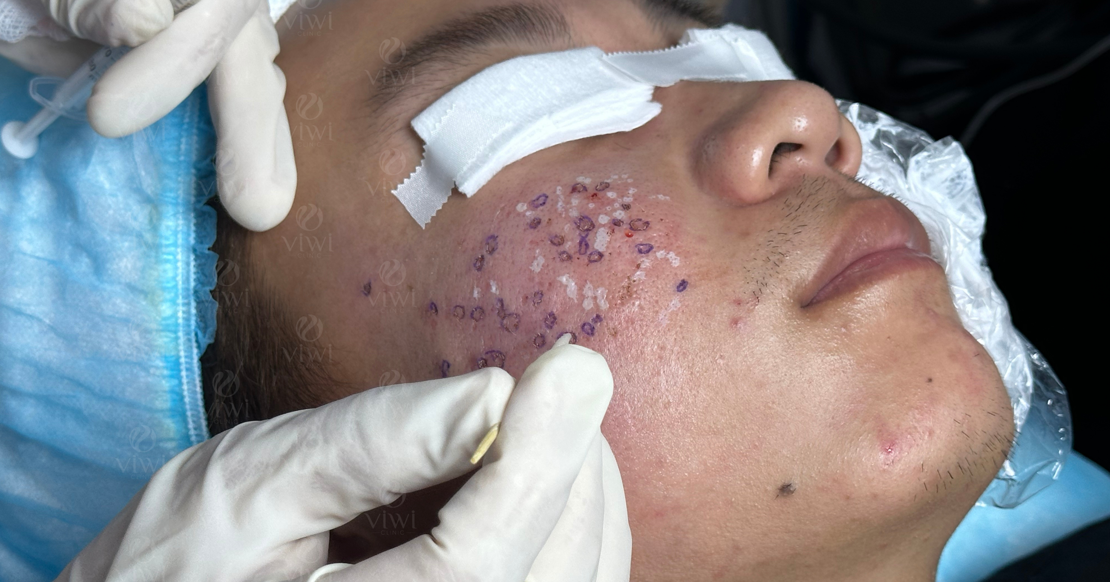 Trị sẹo rỗ tại nhà