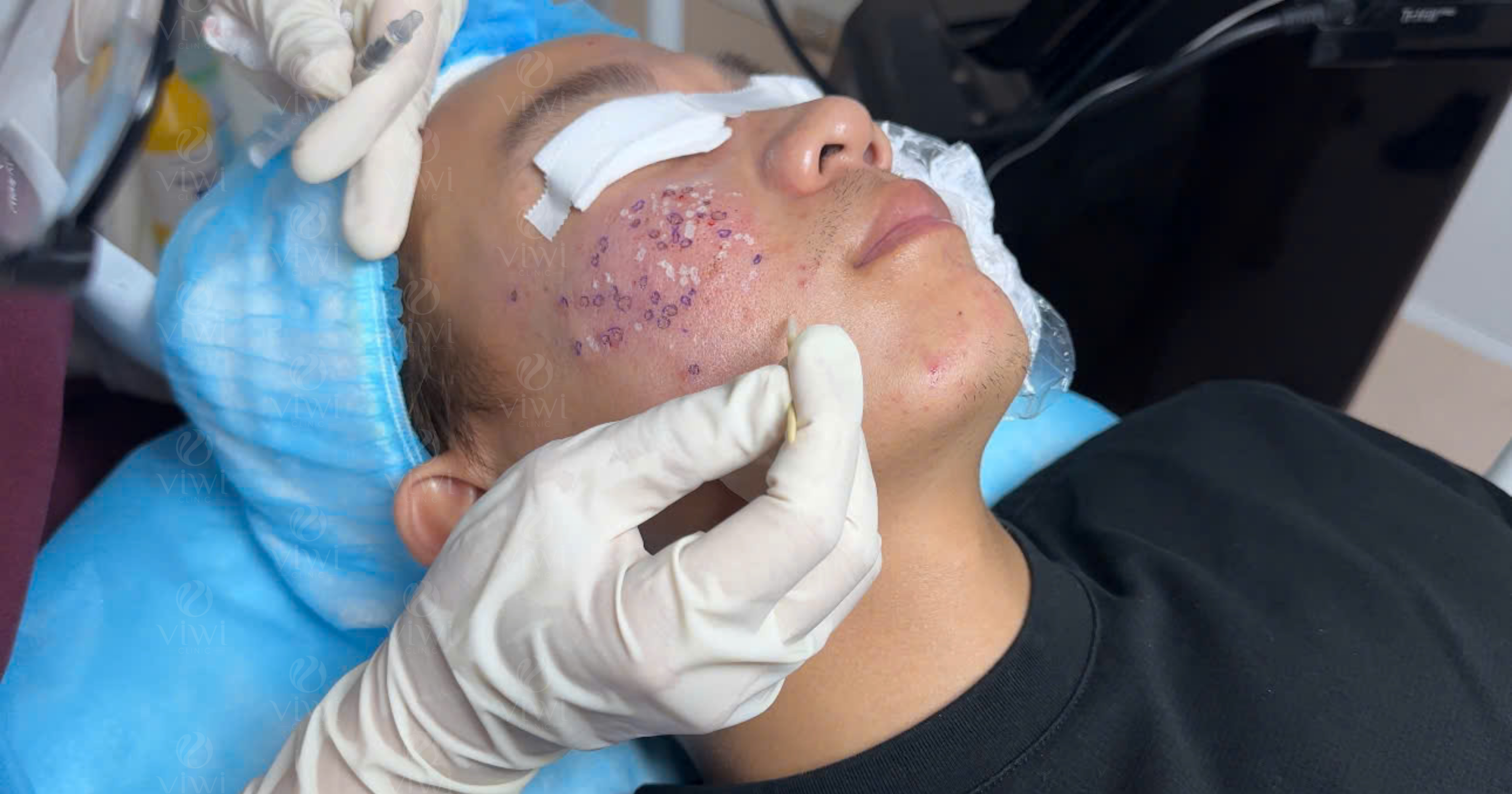 Sẹo đáy nhọn có tự hết không