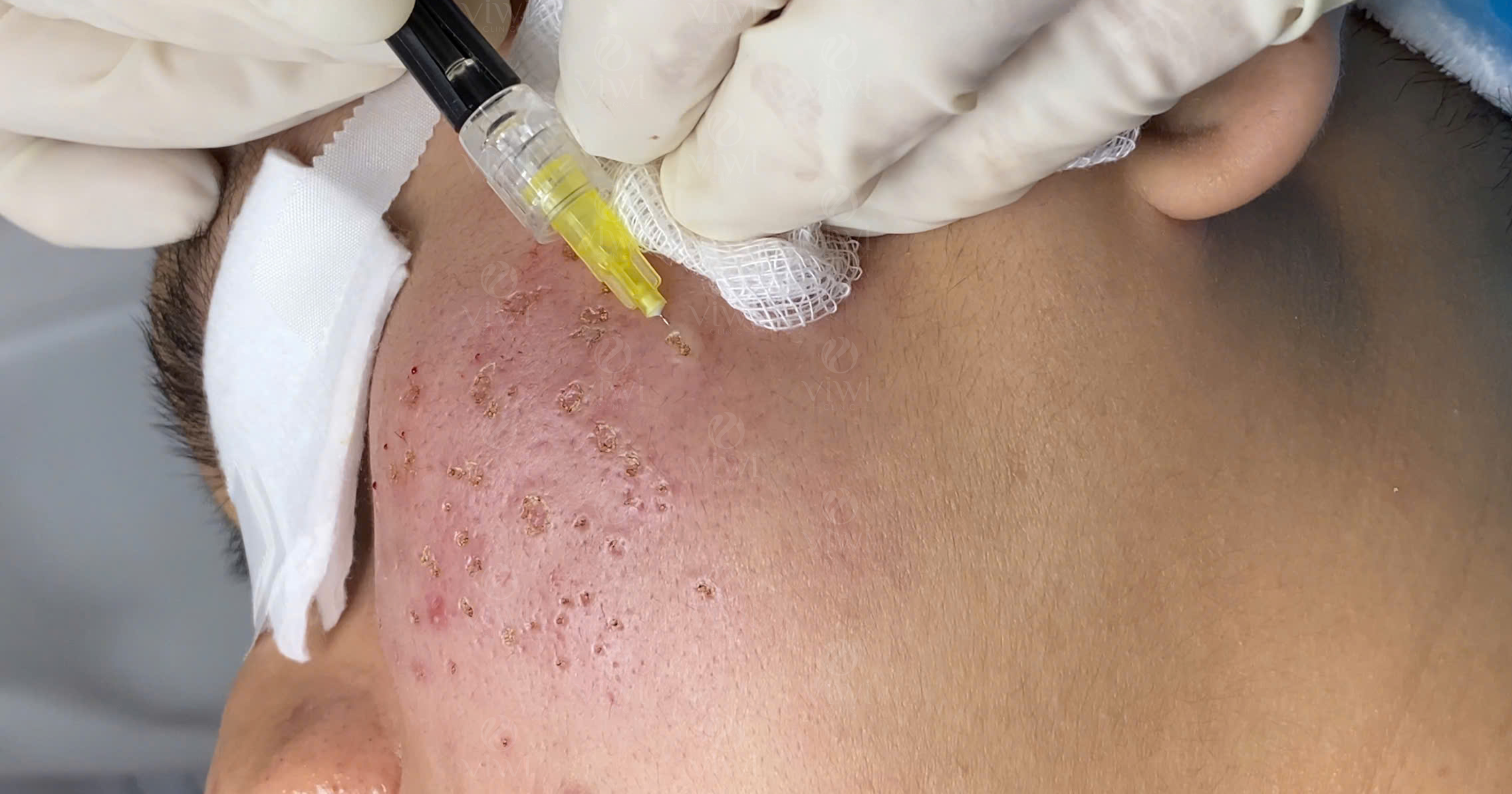 tách đáy sẹo bằng khí 