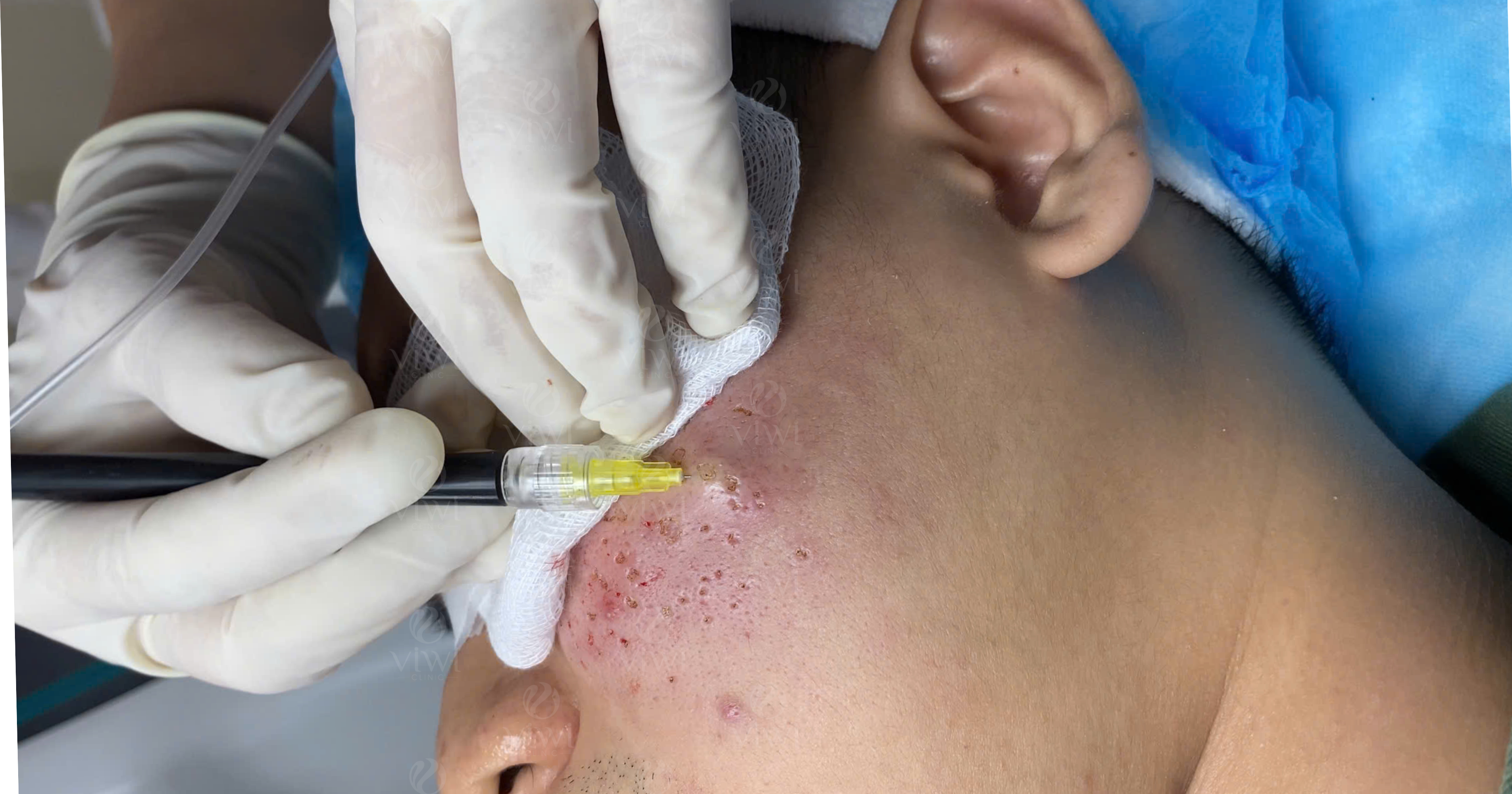 tách đáy sẹo bằng khí 