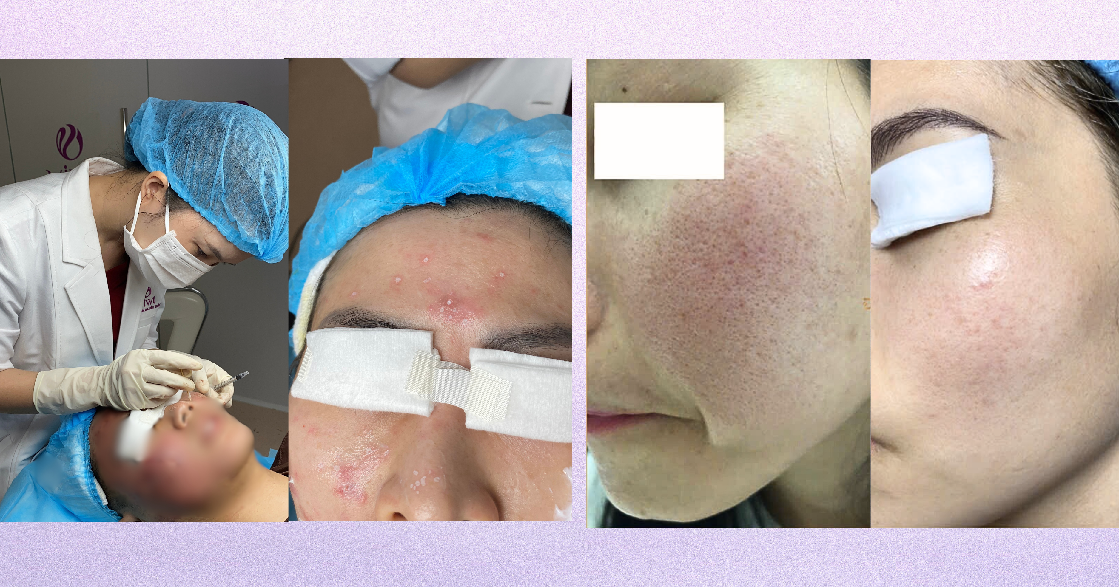 Sẹo đáy nhọn có tự hết không