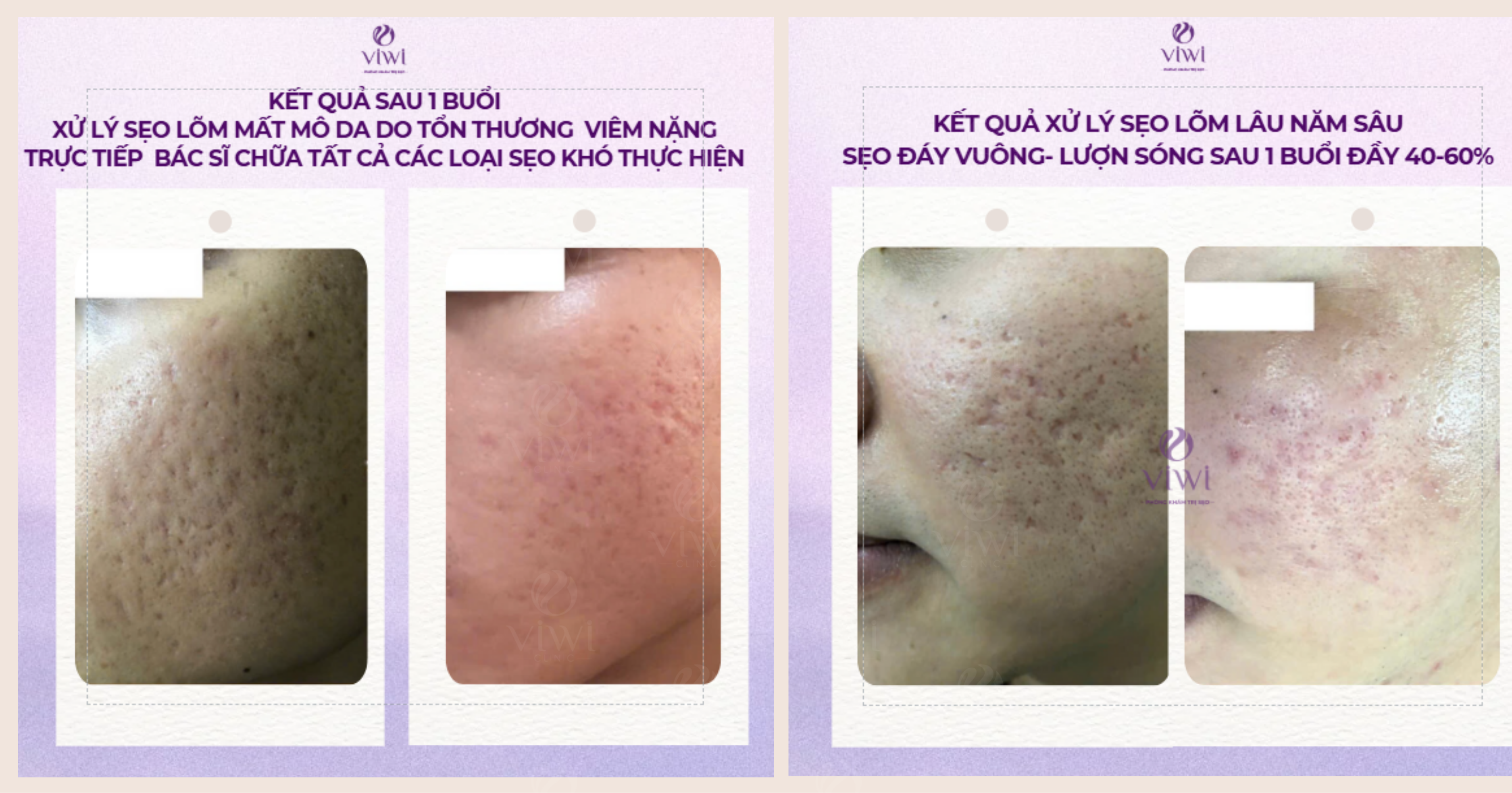 Trị sẹo rỗ tại nhà