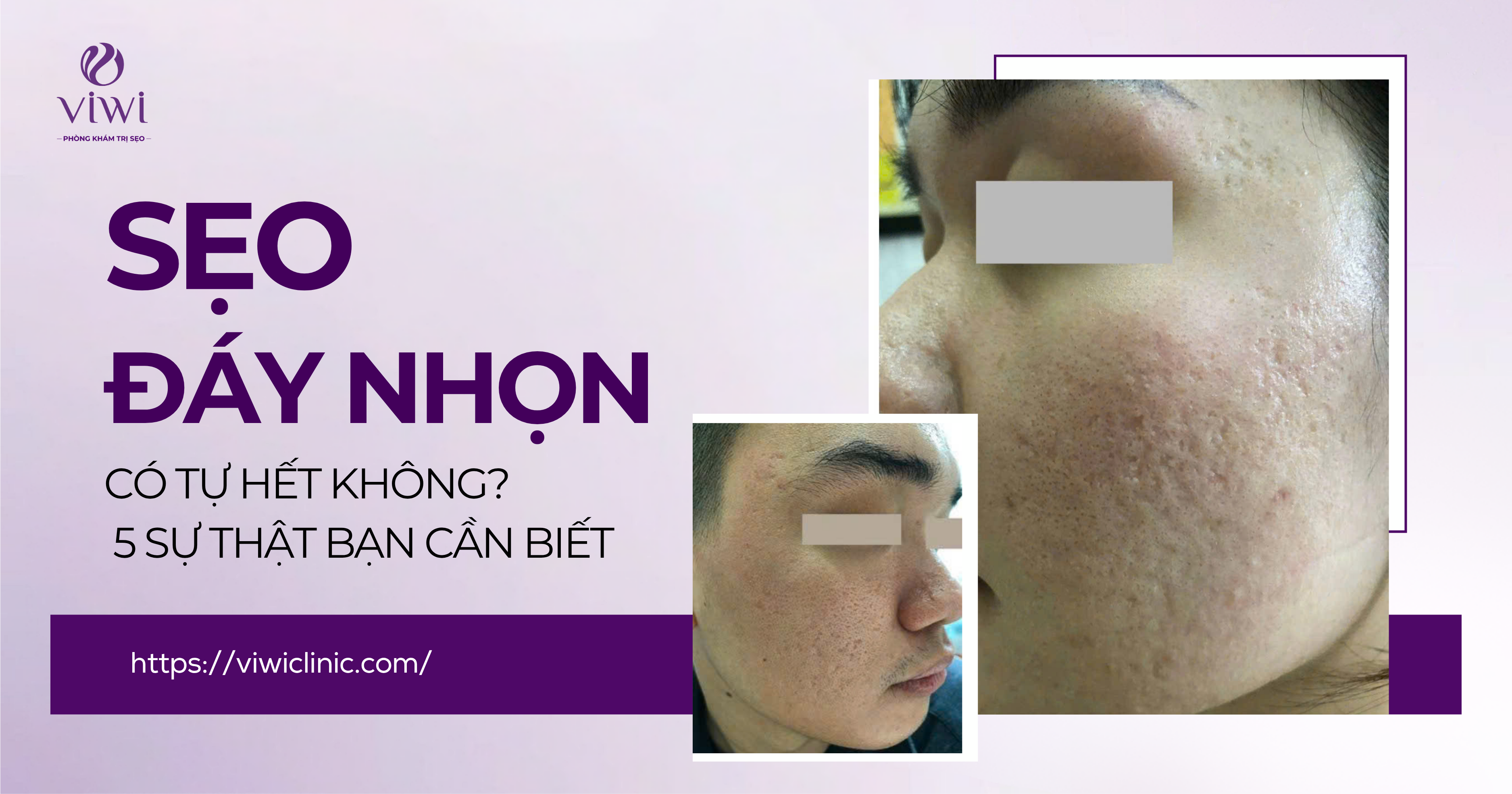 sẹo đáy nhọn có tự hết không