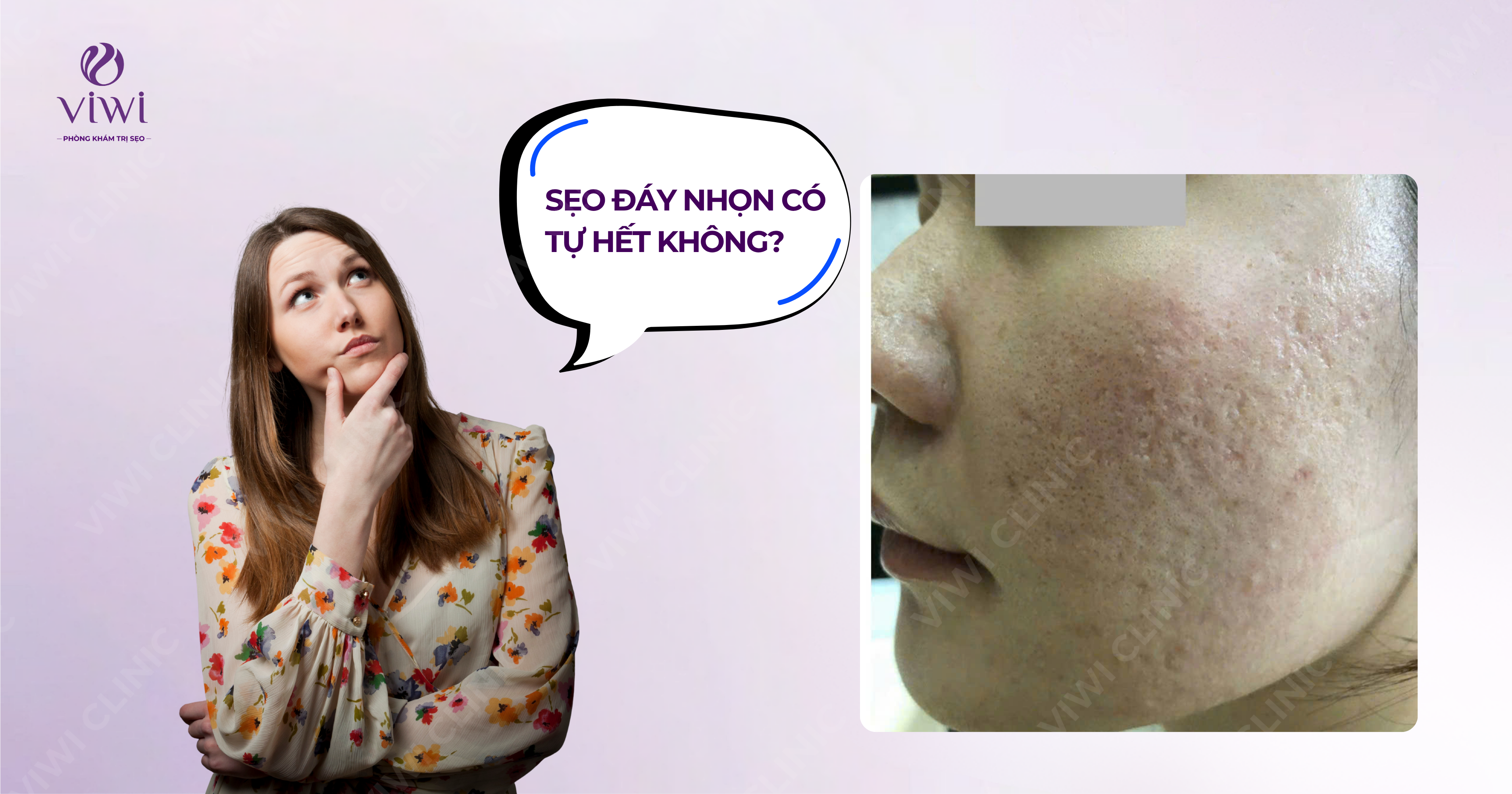 Sẹo đáy nhọn có tự hết không