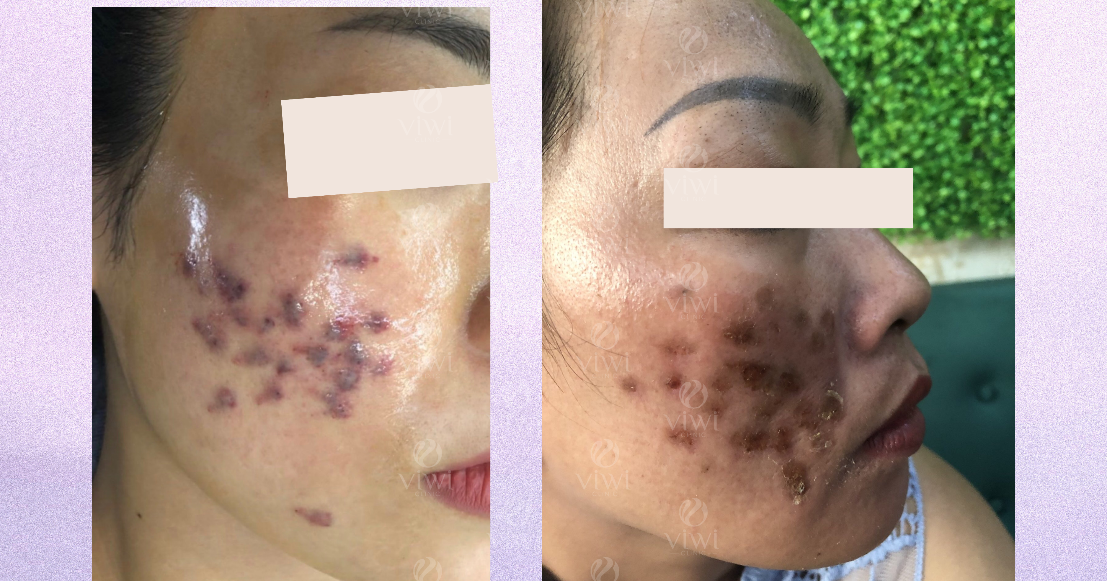 Địa chỉ trị sẹo uy tín hiệu quả ở HCM