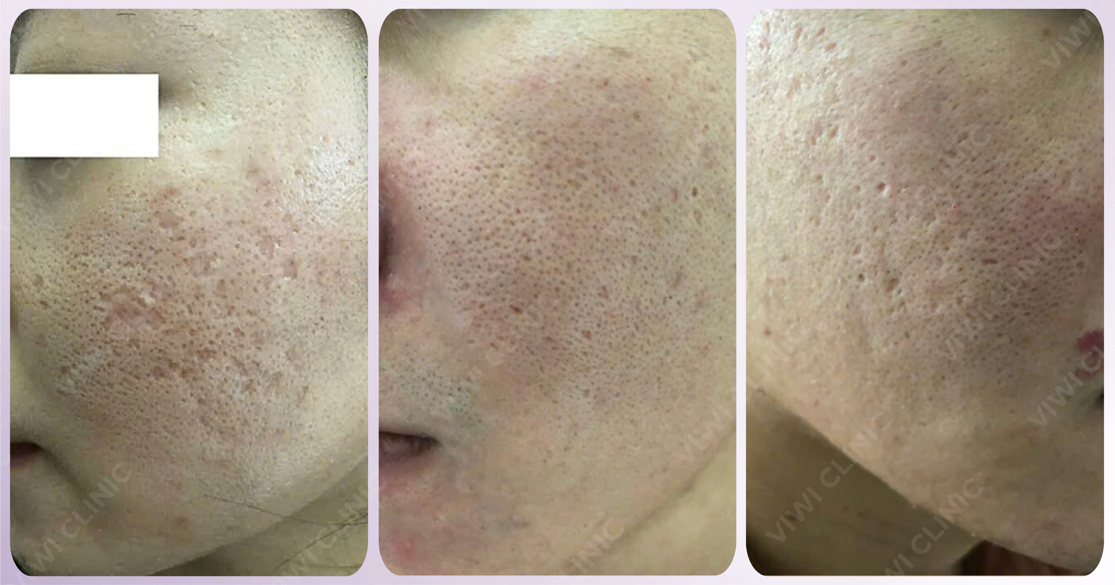 Sẹo đáy nhọn có tự hết không