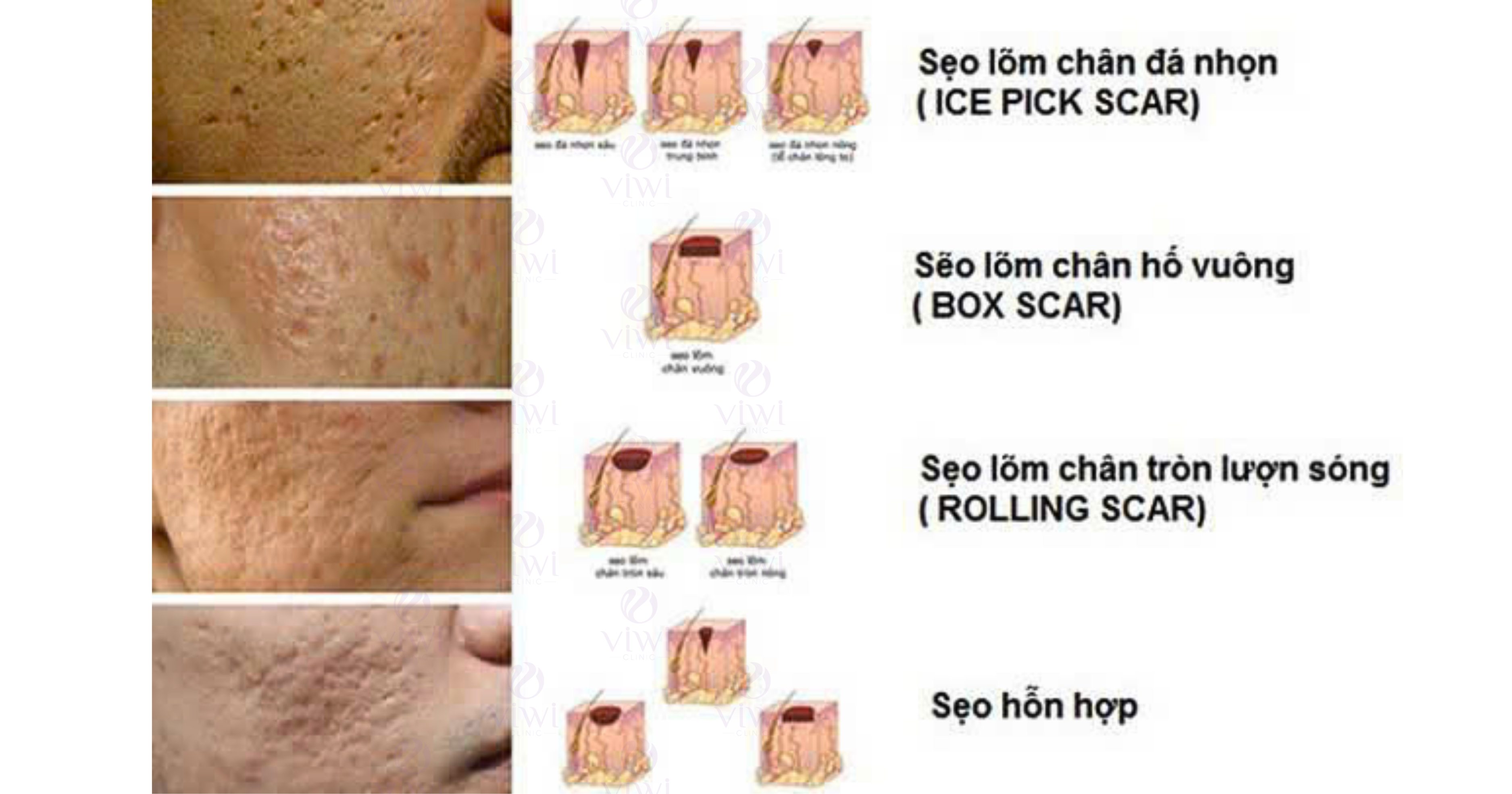 Sẹo rỗ lâu năm