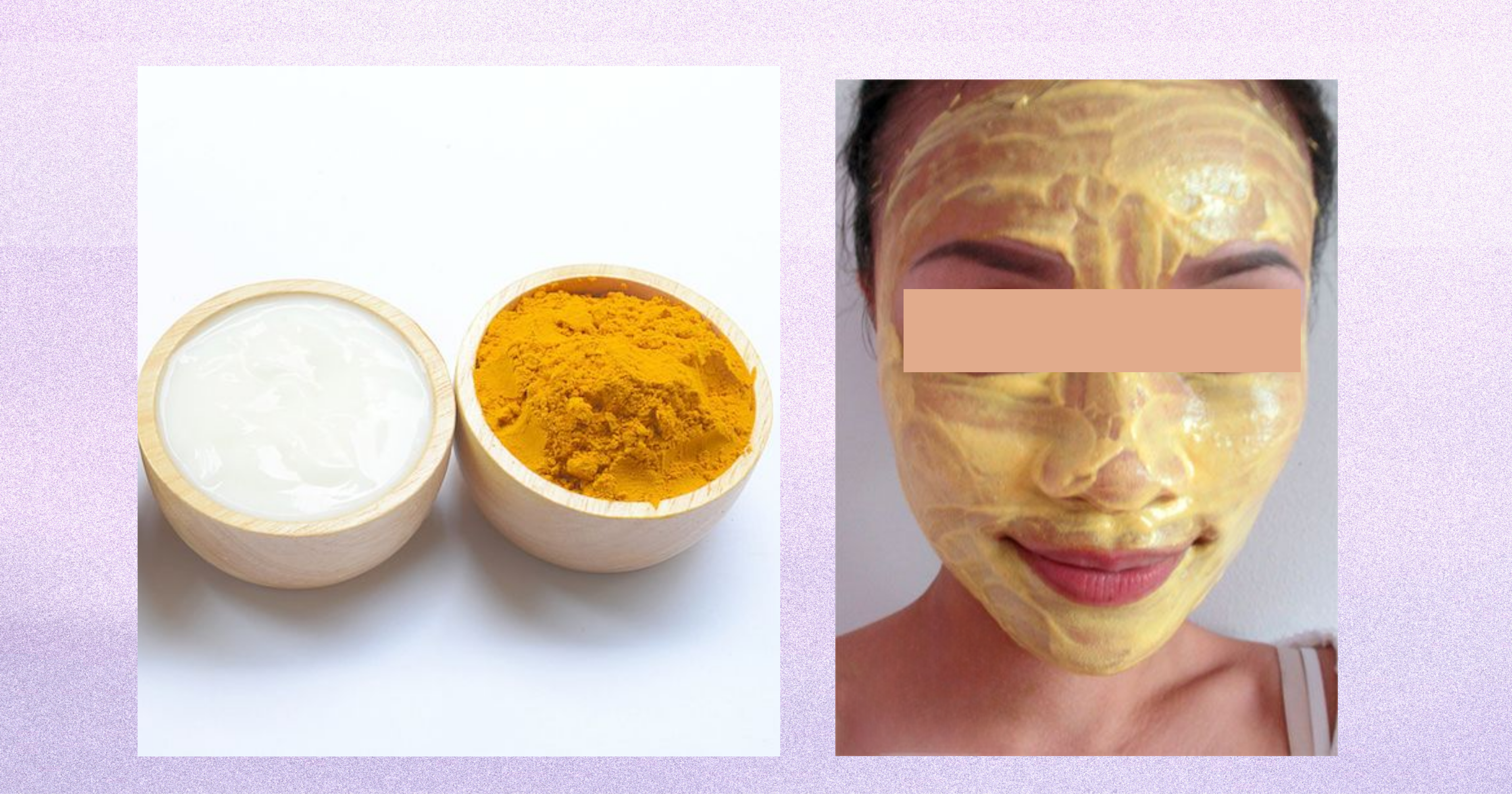 Trị sẹo rỗ tại nhà