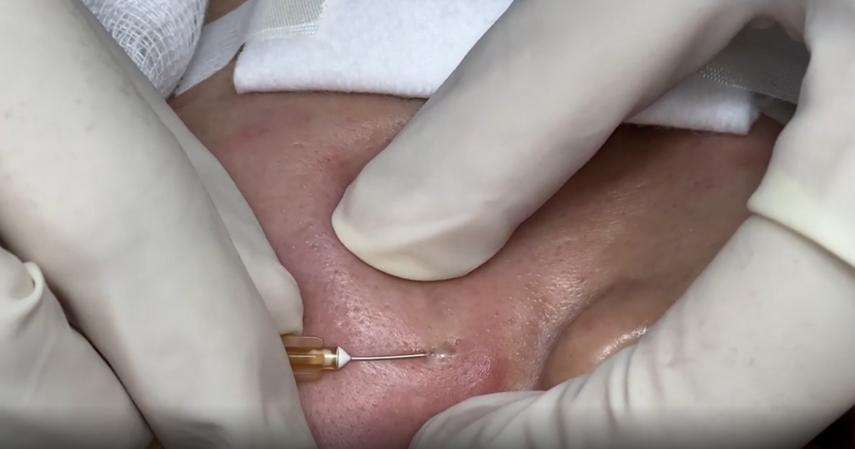 Trị sẹo rỗ tại nhà