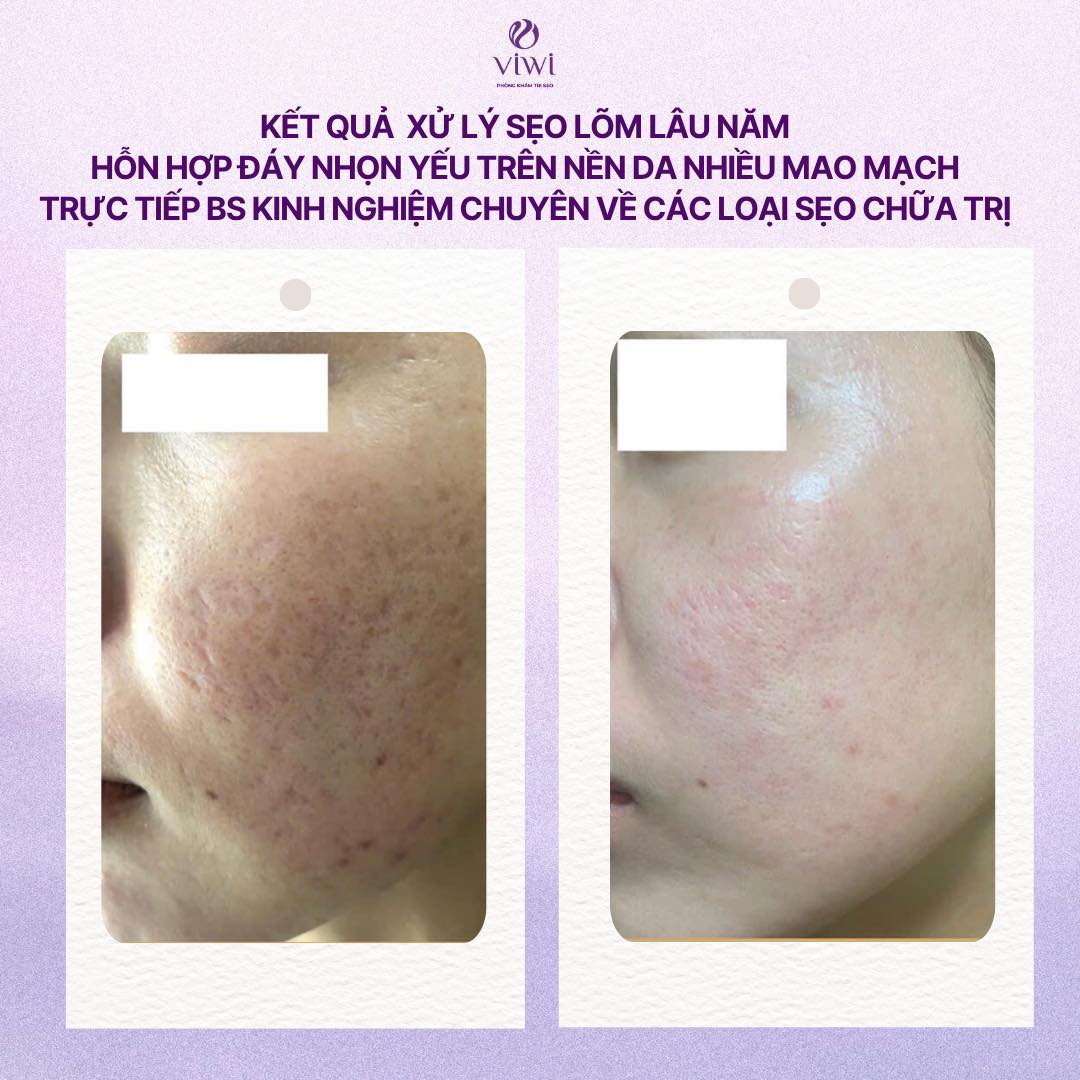 Sẹo đáy nhọn có tự hết không