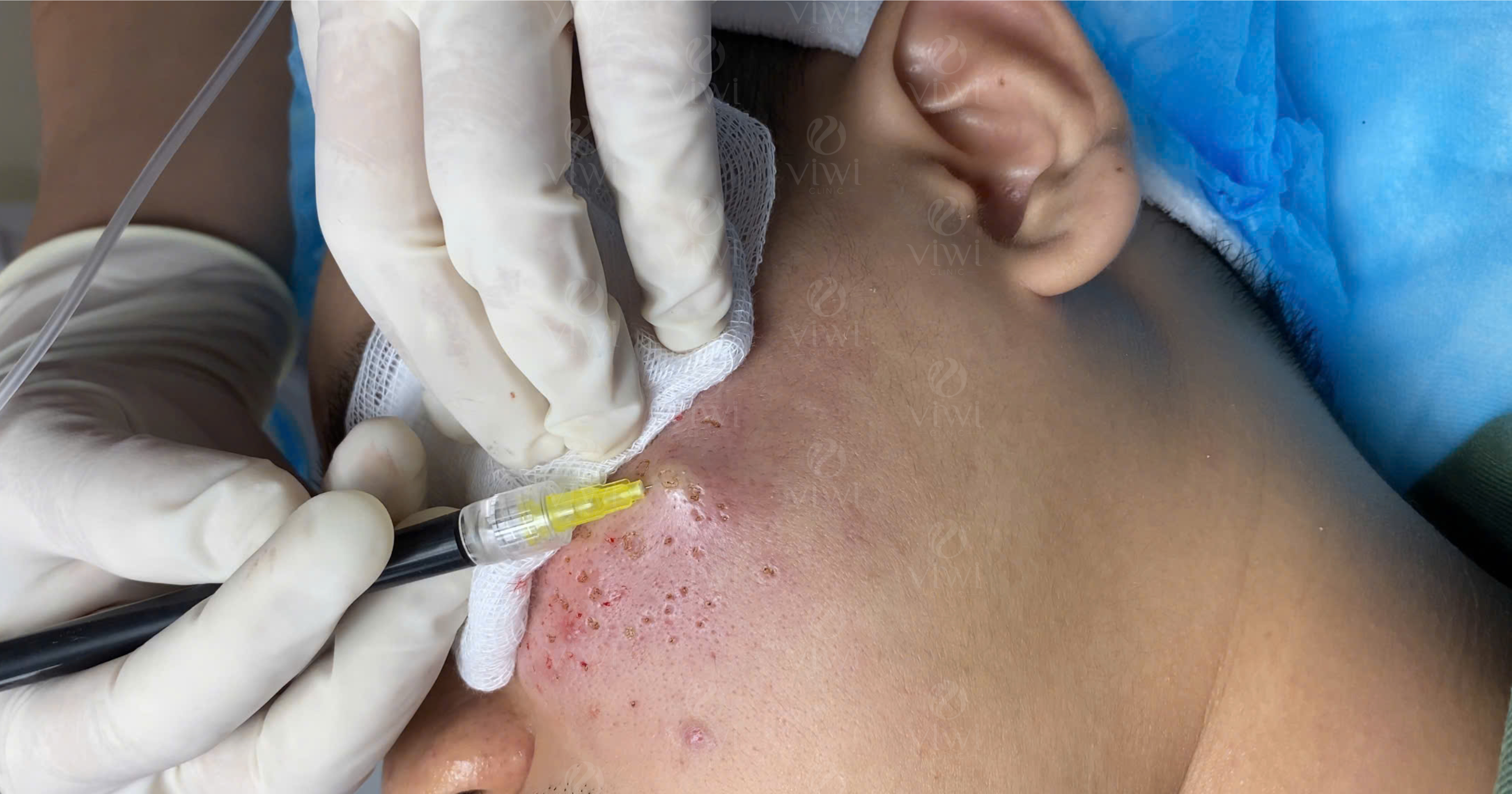 trị sẹo rỗ lâu năm