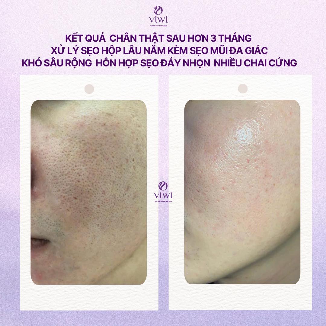 Sẹo đáy nhọn có tự hết không