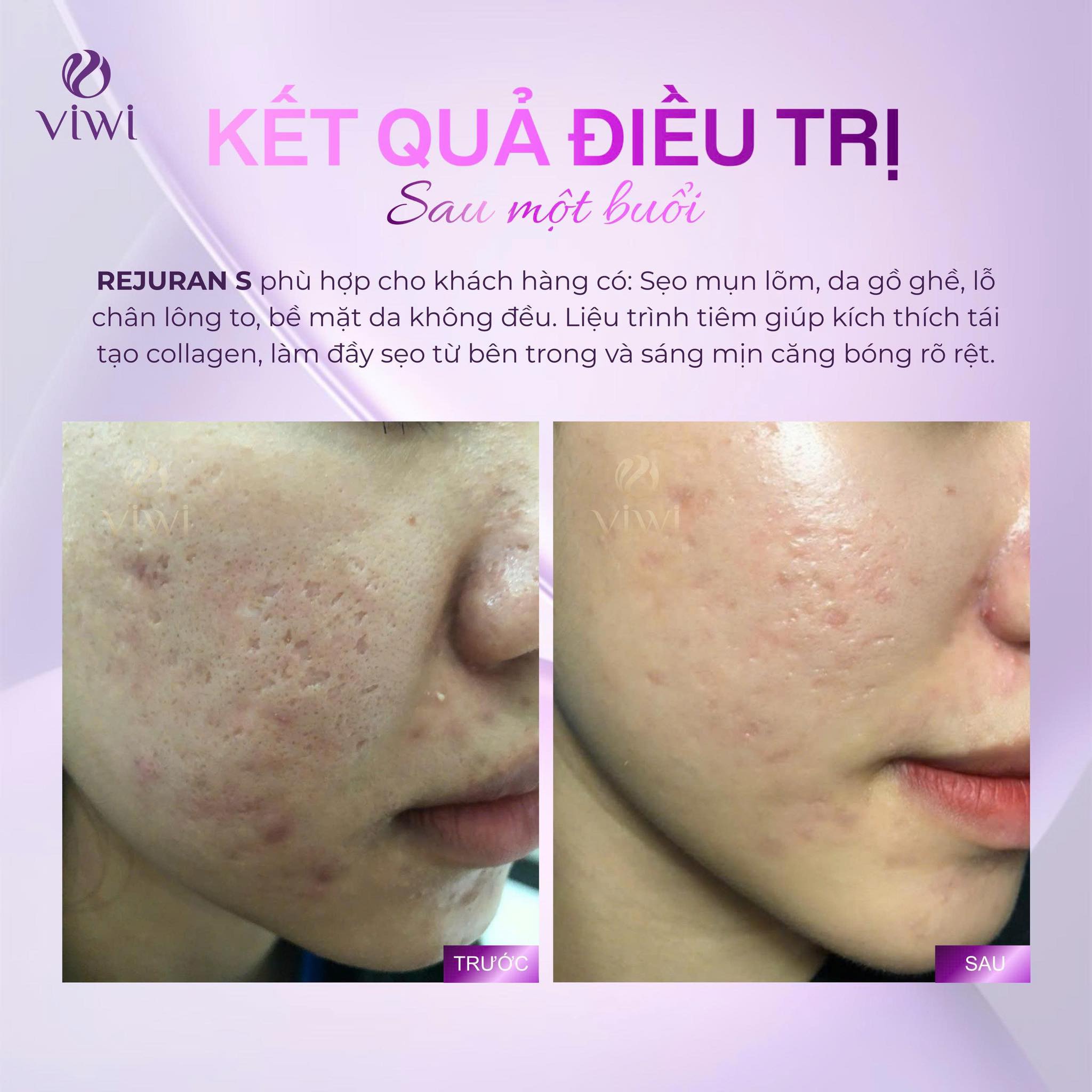 Địa chỉ trị sẹo uy tín hiệu quả ở HCM