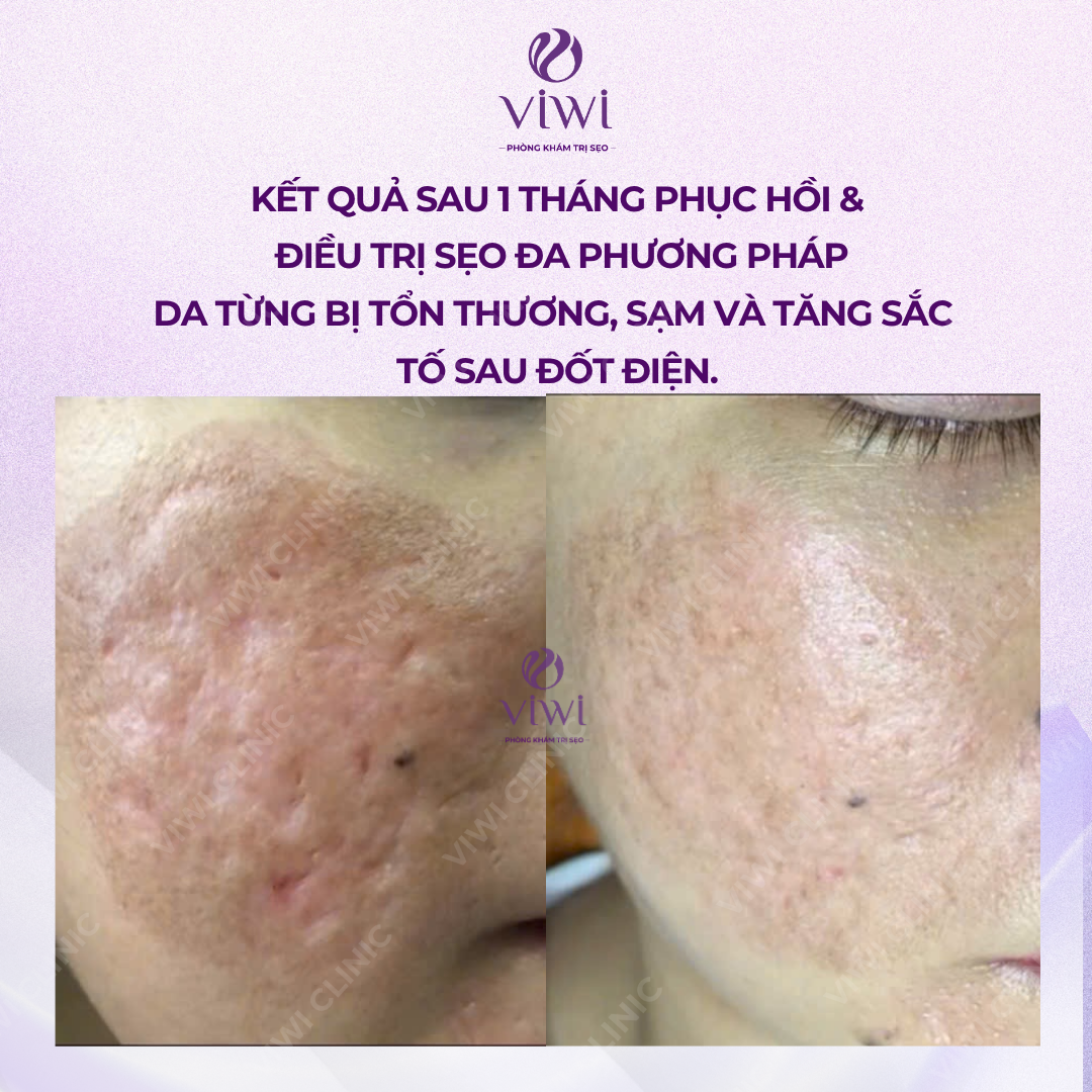 Liệu Trình Điều Trị Sẹo Rỗ Tại Phòng Khám TPHCM