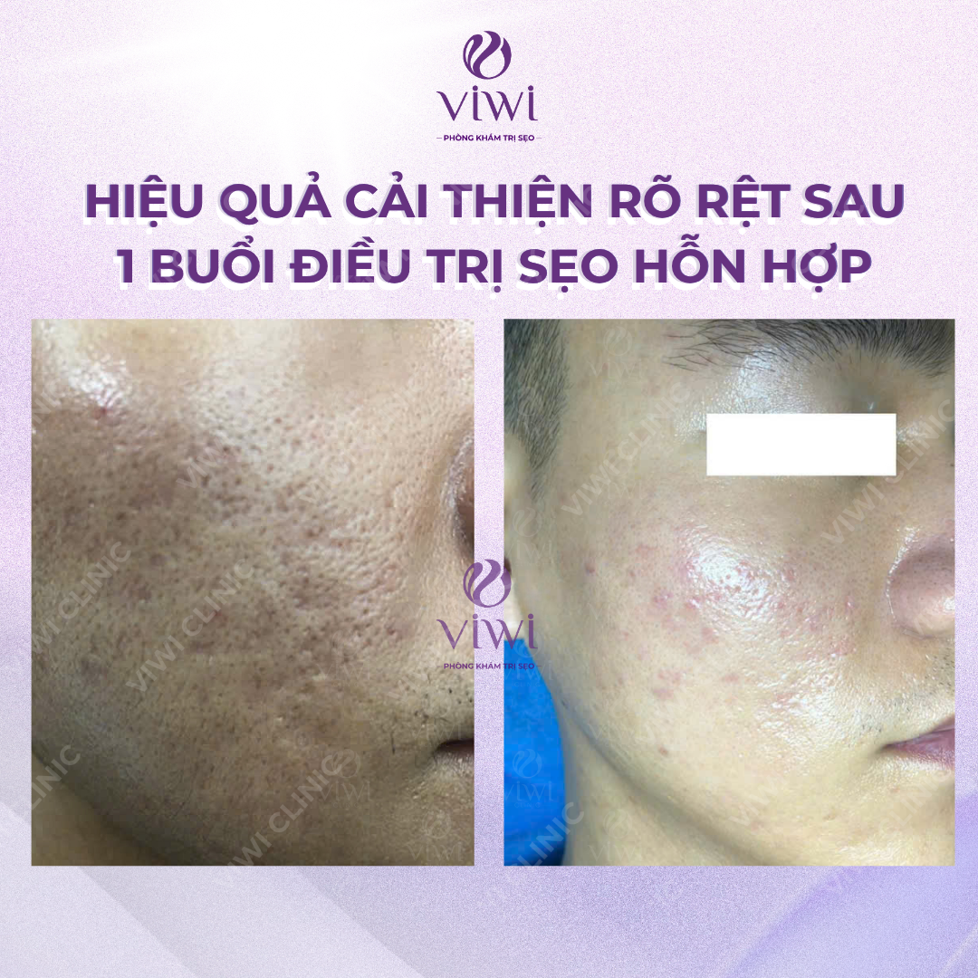 Liệu Trình Điều Trị Sẹo Rỗ Tại Phòng Khám TPHCM