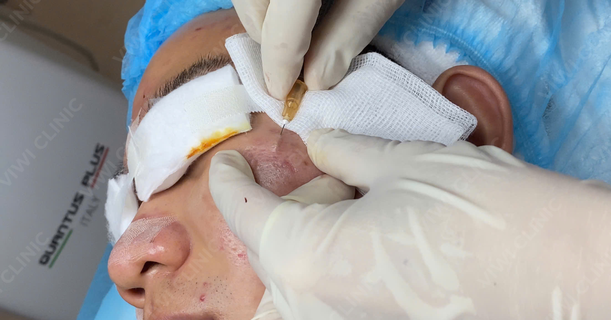 Trị Sẹo Rỗ Tại Phòng Khám TPHCM