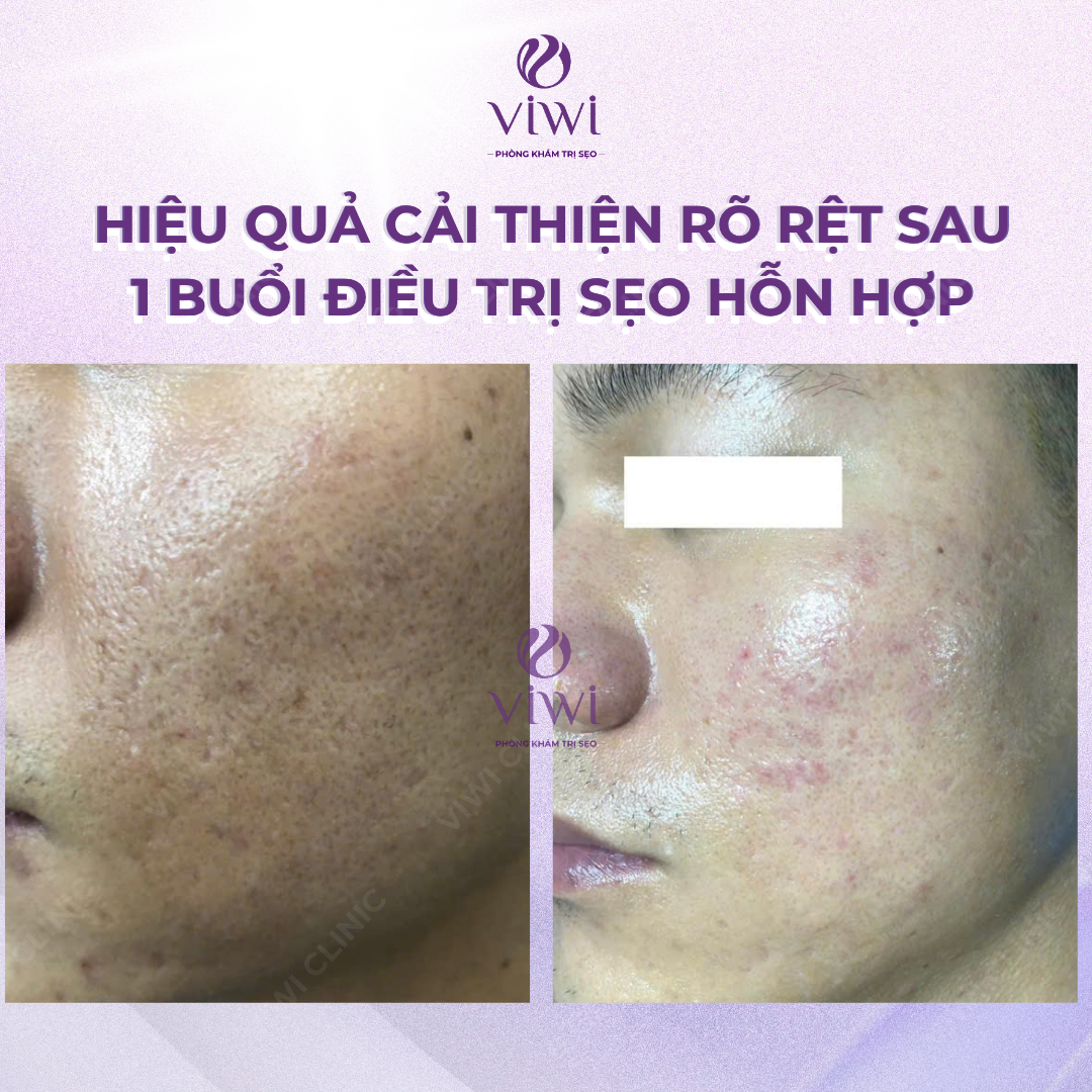Liệu Trình Điều Trị Sẹo Rỗ Tại Phòng Khám TPHCM
