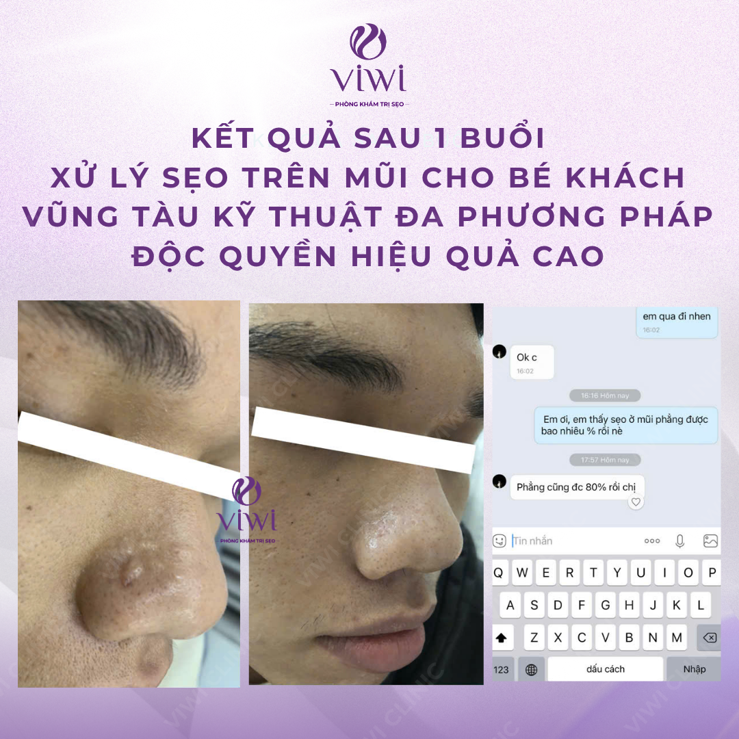 Liệu Trình Điều Trị Sẹo Rỗ Tại Phòng Khám TPHCM