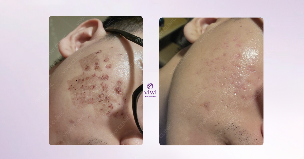 Cắt đáy sẹo có đau không