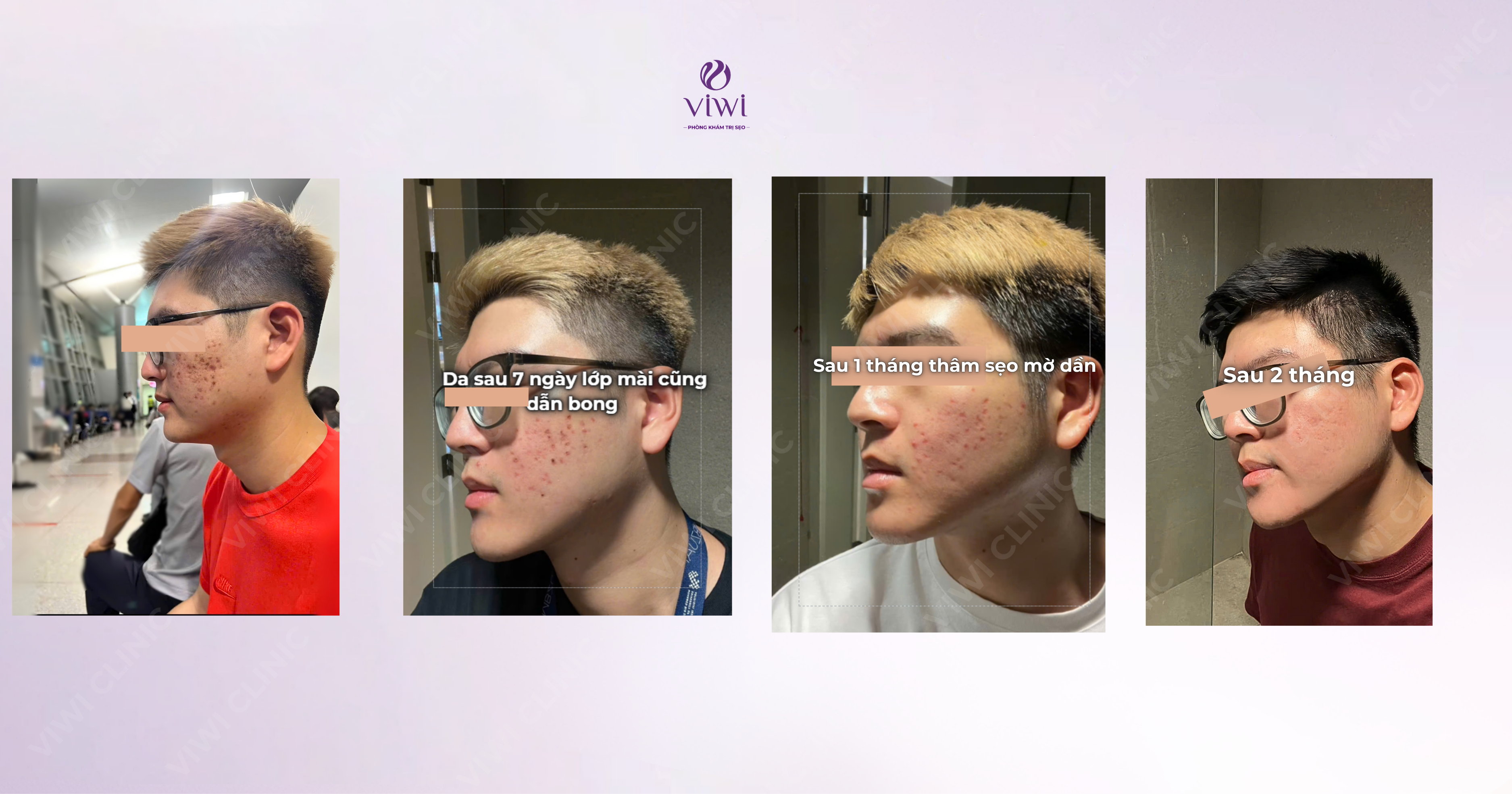 Cắt đáy sẹo có đau không