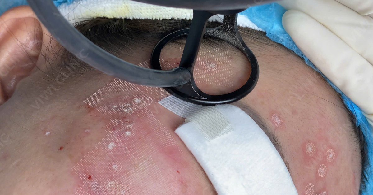 Trị Sẹo Rỗ Tại Phòng Khám TPHCM