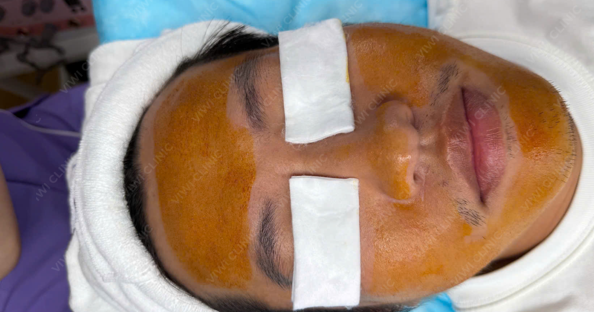 RF Needle có tác dụng gì