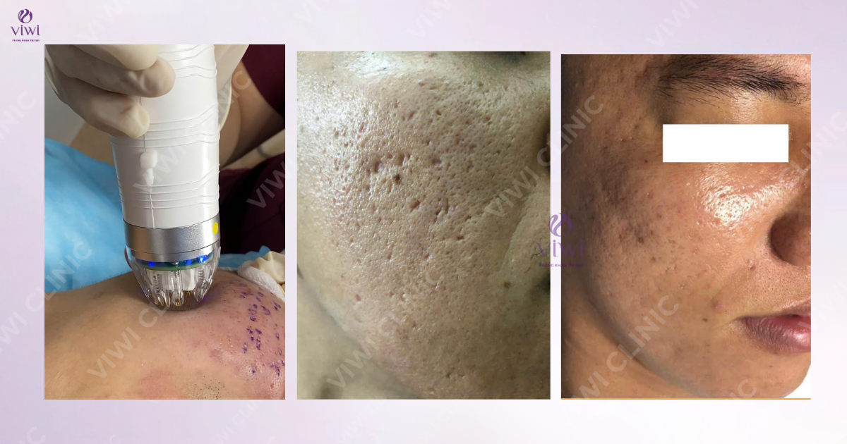 RF needle trị sẹo đáy nhọn hiệu quả