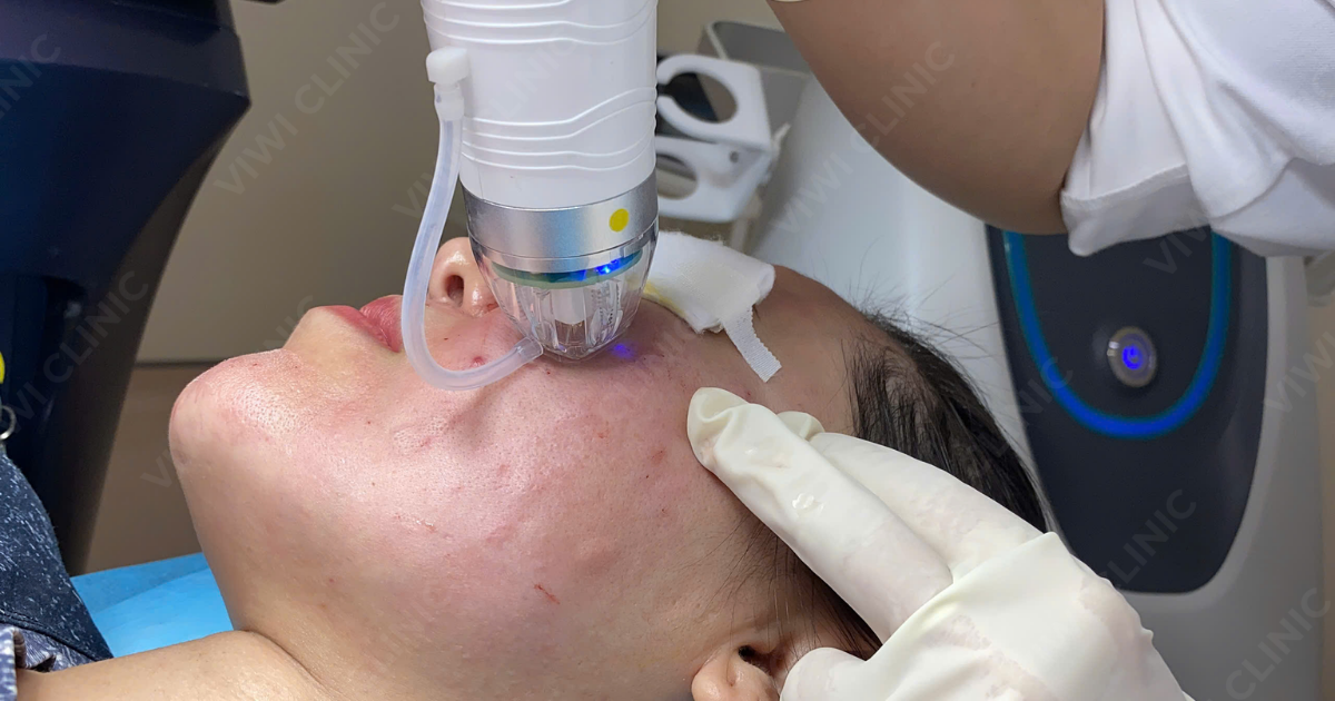 RF needle trị sẹo đáy nhọn hiệu quả