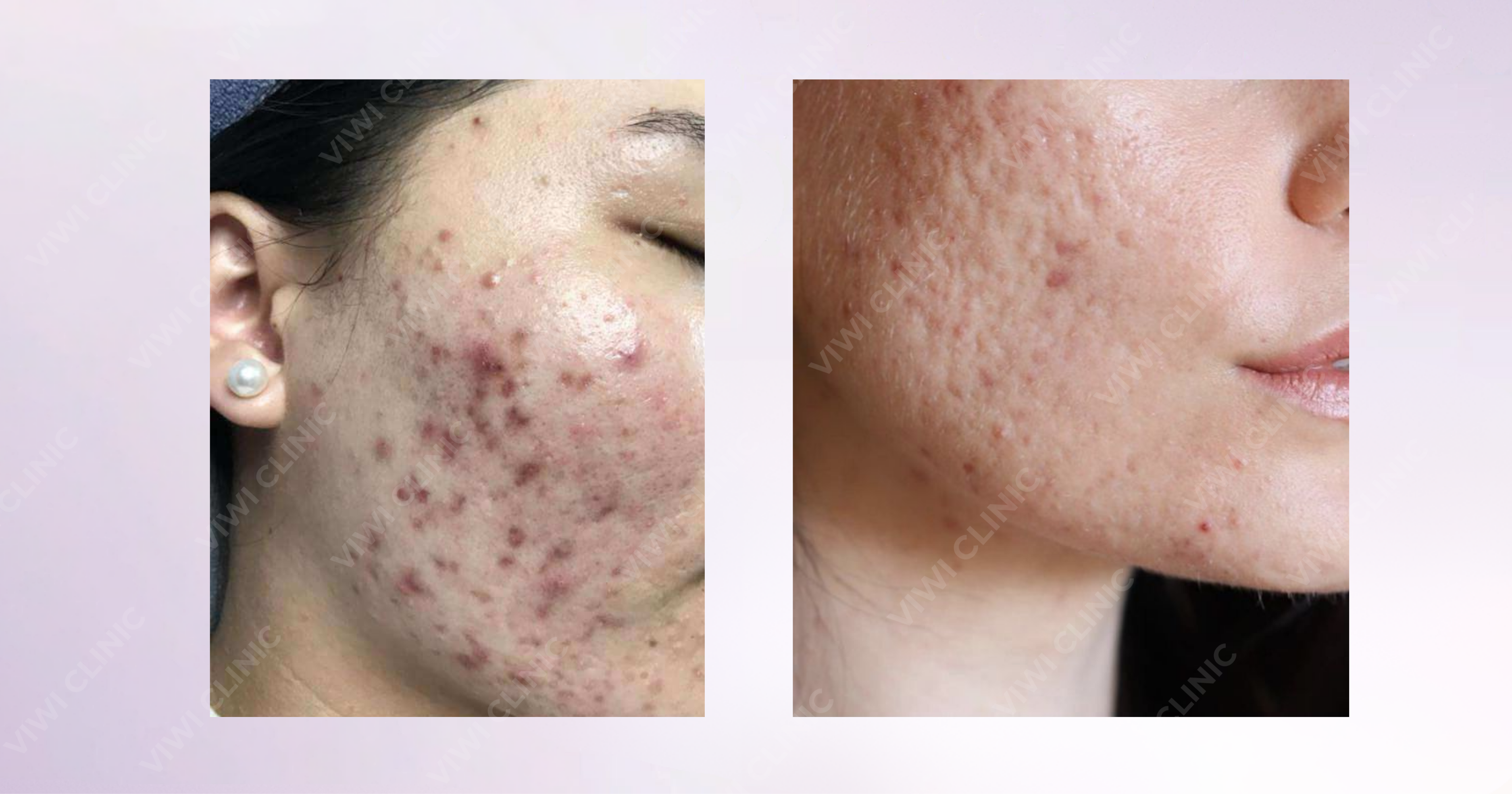 Sẹo rỗ có tự hết không