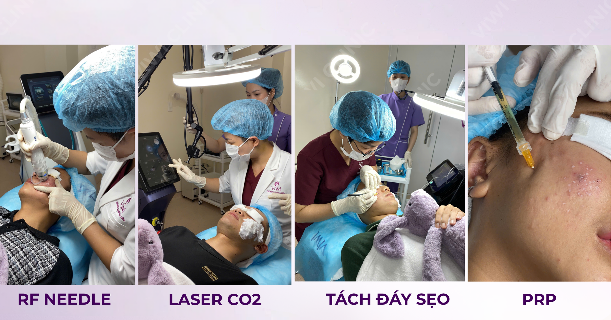 Trị sẹo rỗ lâu năm ở đâu hiệu quả và an toàn tại TPHCM