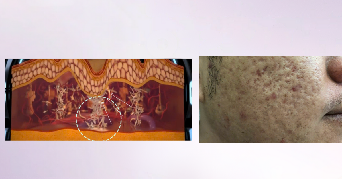 Sẹo rỗ lâu năm có trị hết hoàn toàn được không