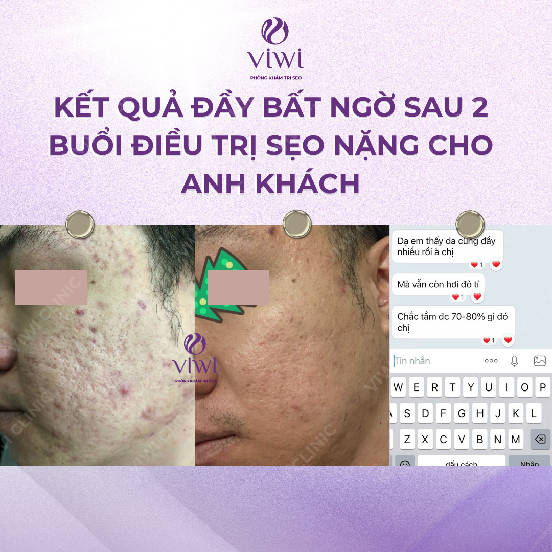 Liệu Trình Điều Trị Sẹo Rỗ Tại Phòng Khám TPHCM