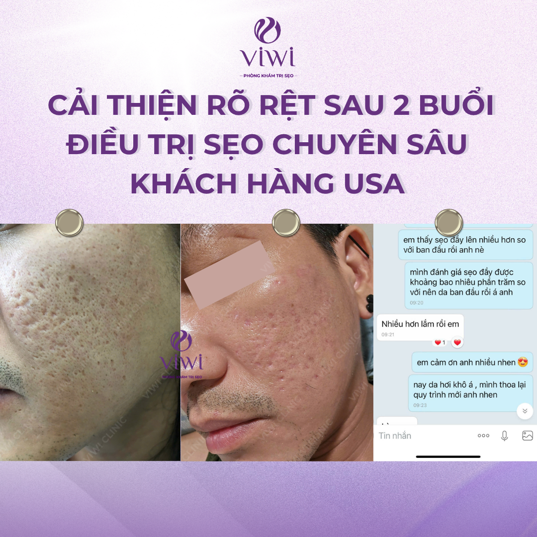 Liệu Trình Điều Trị Sẹo Rỗ Tại Phòng Khám TPHCM