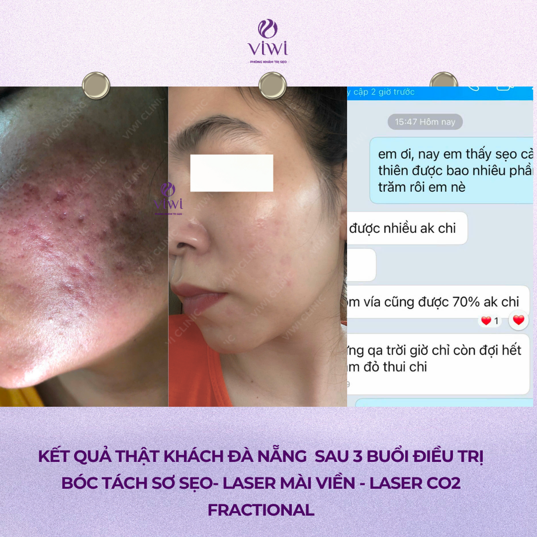 Liệu Trình Điều Trị Sẹo Rỗ Tại Phòng Khám TPHCM