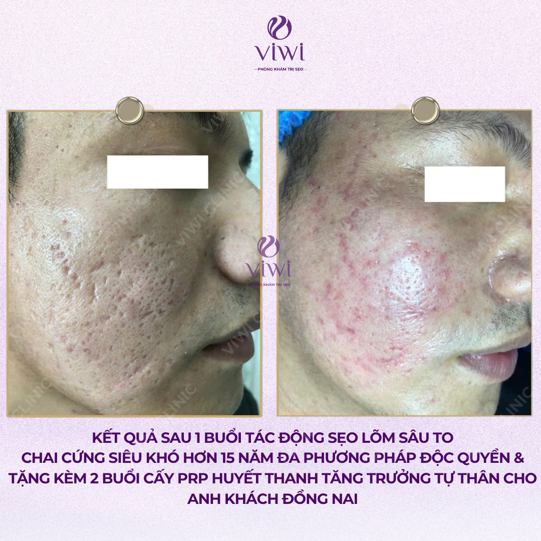 Liệu Trình Điều Trị Sẹo Rỗ Tại Phòng Khám TPHCM