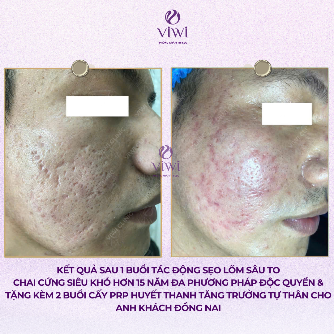 Liệu Trình Điều Trị Sẹo Rỗ Tại Phòng Khám TPHCM