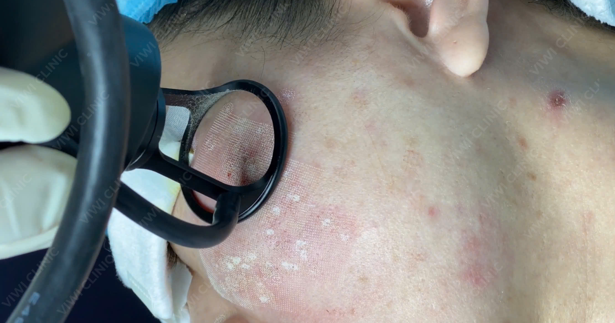 Laser Fractional Co2 trị sẹo rỗ có để lại thâm không