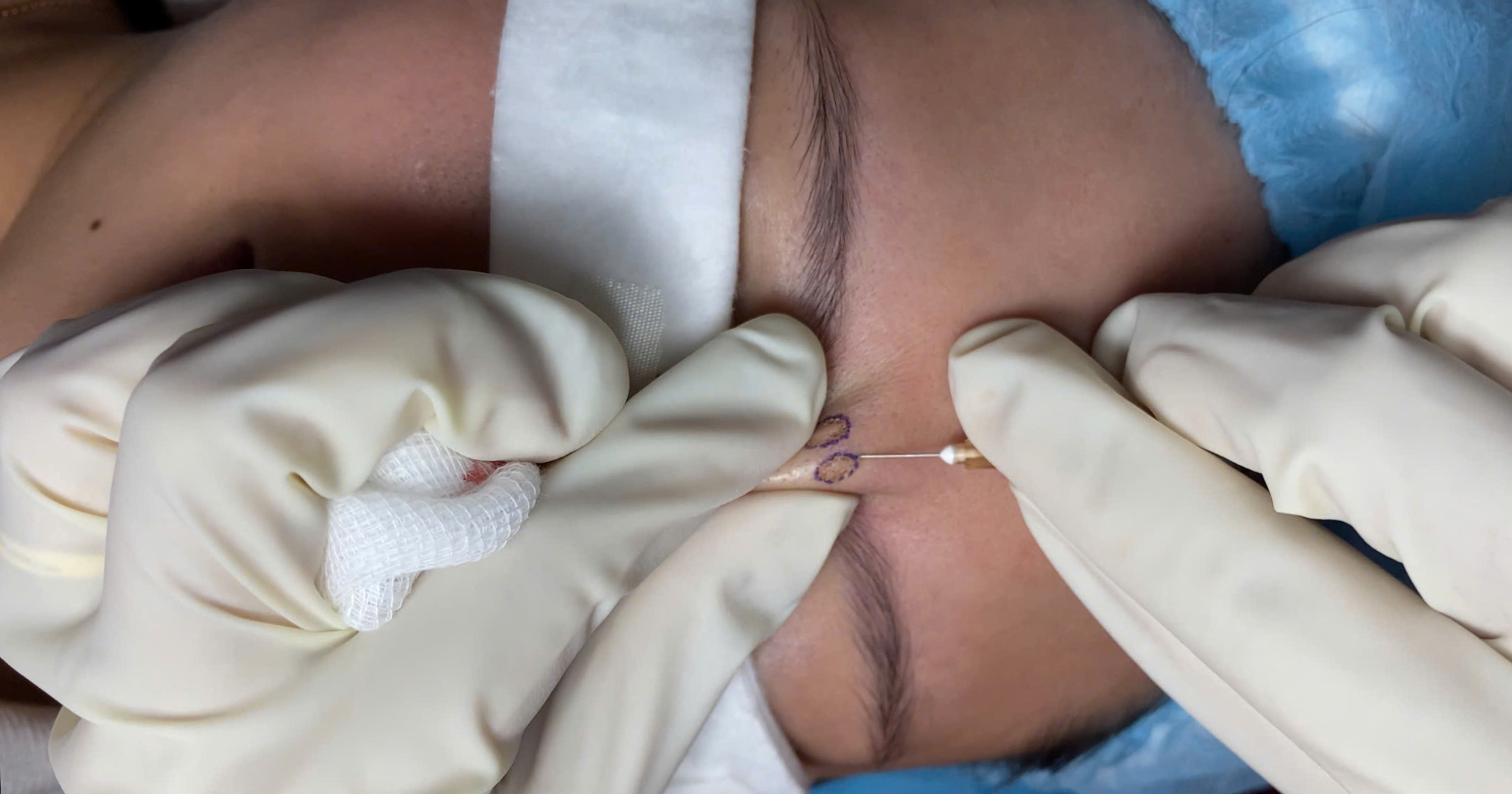 Tách xơ sẹo sâu bao lâu hồi phục có để lại bầm không