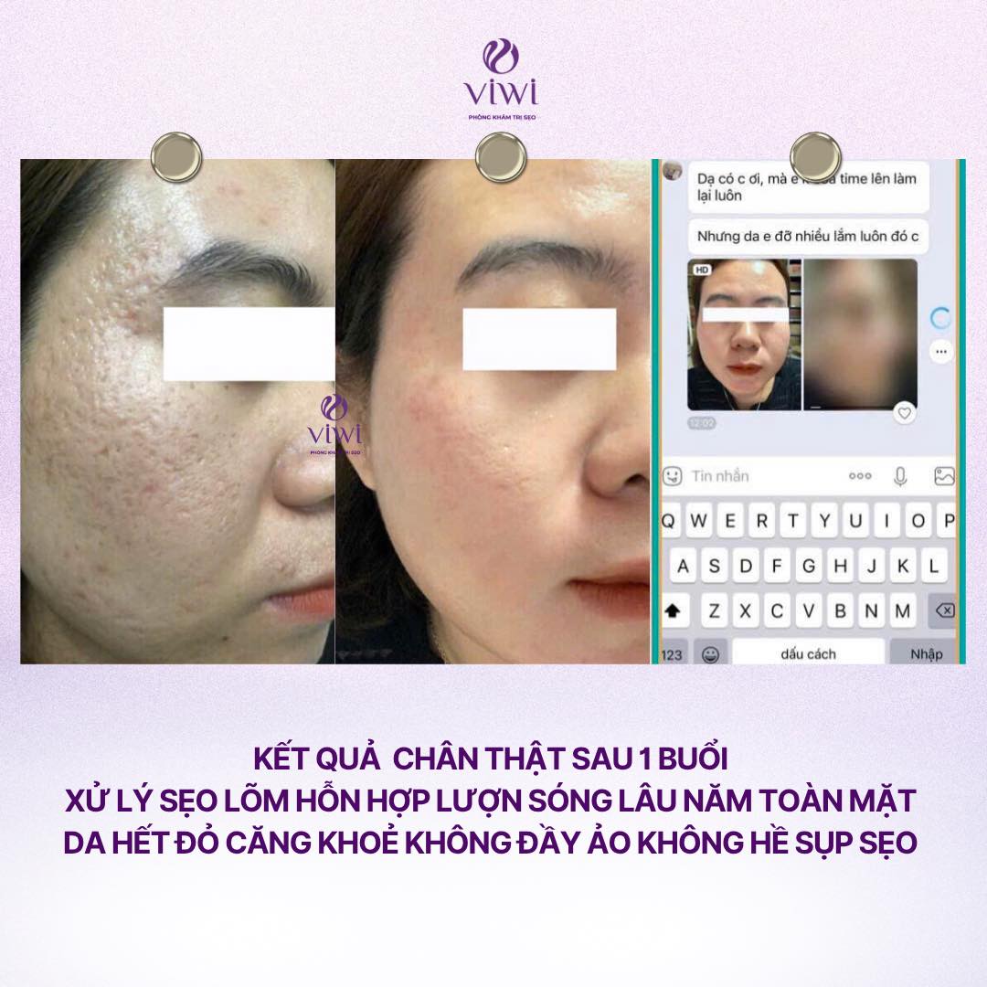 RF Needle có đau không và có bị thâm không