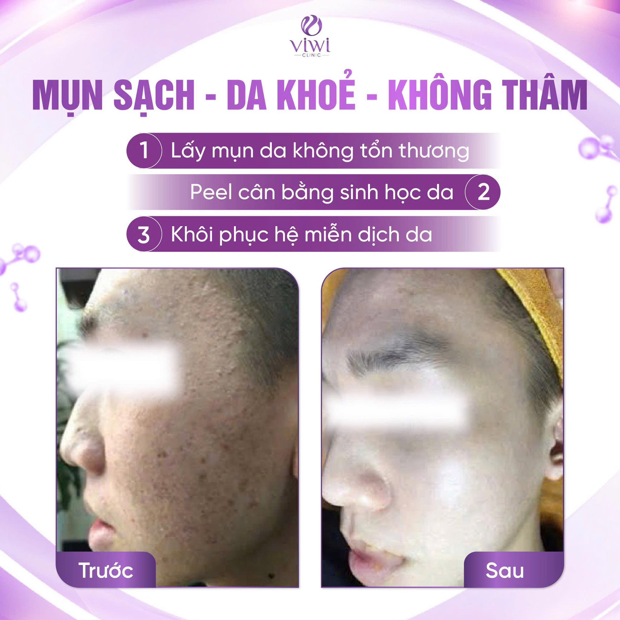Trị thâm sau mụn