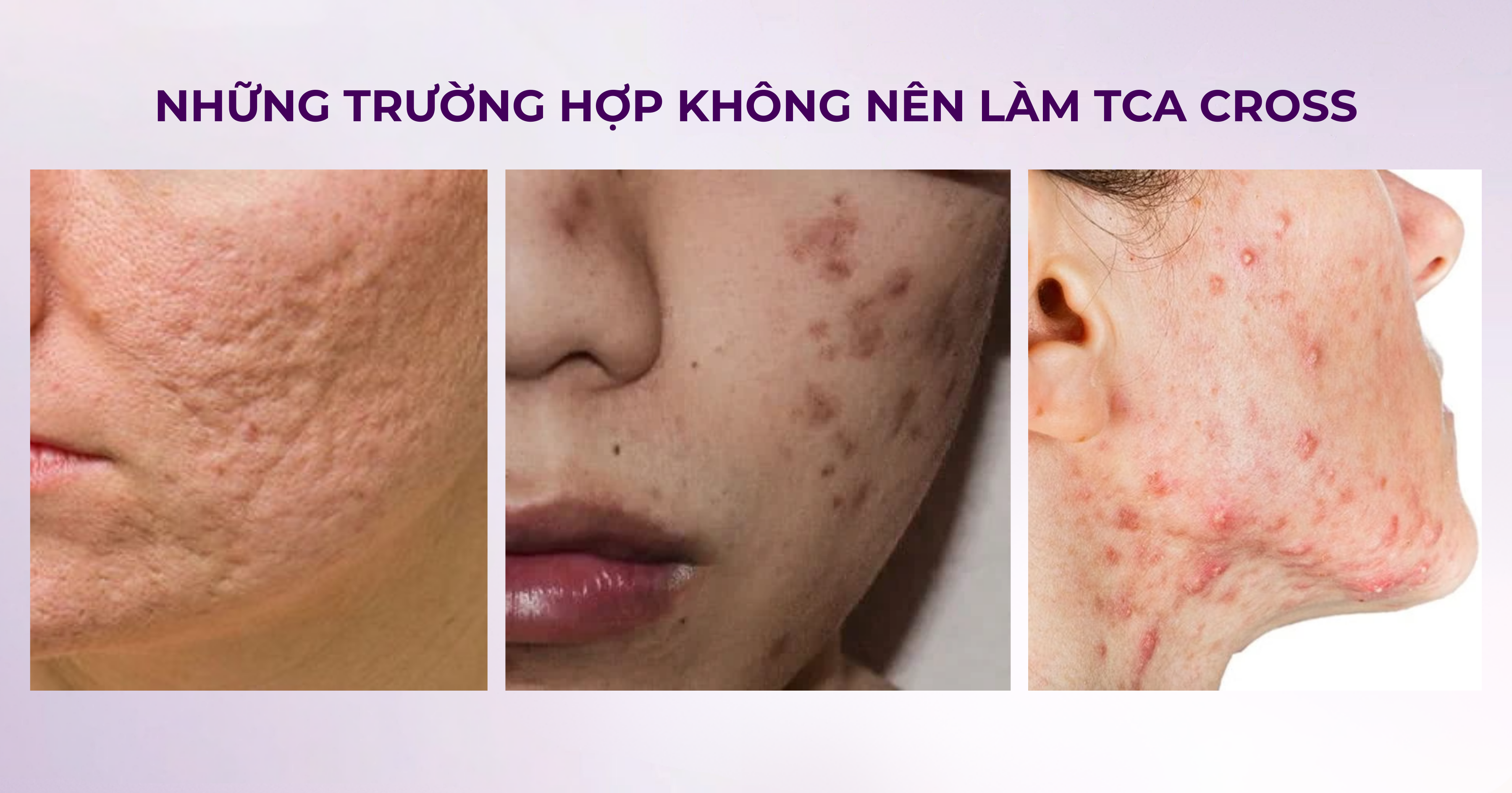 Tca cross trị sẹo lõm có nguy hiểm không có nên làm không