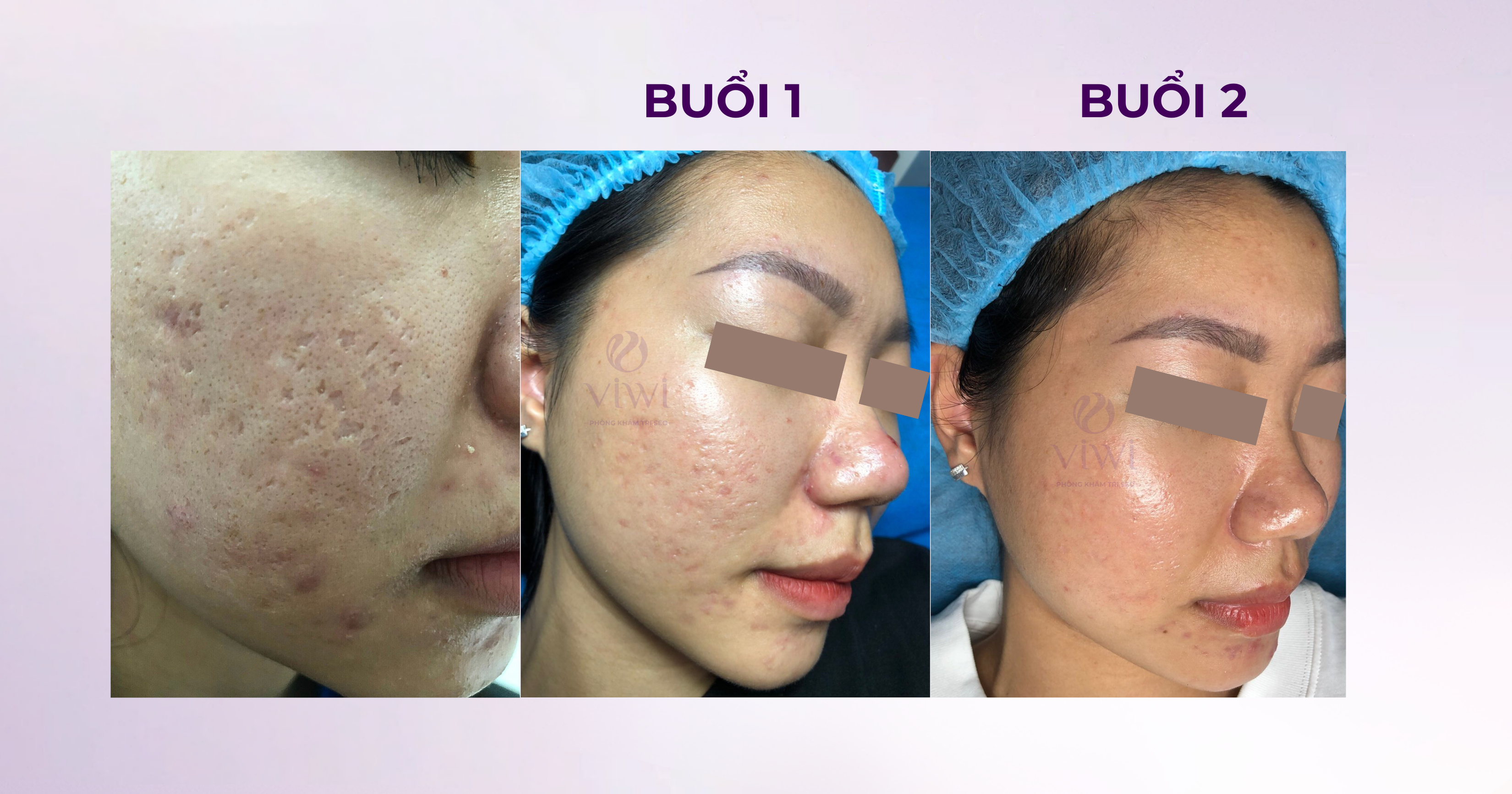 Sẹo rỗ lâu năm có trị hết hoàn toàn được không