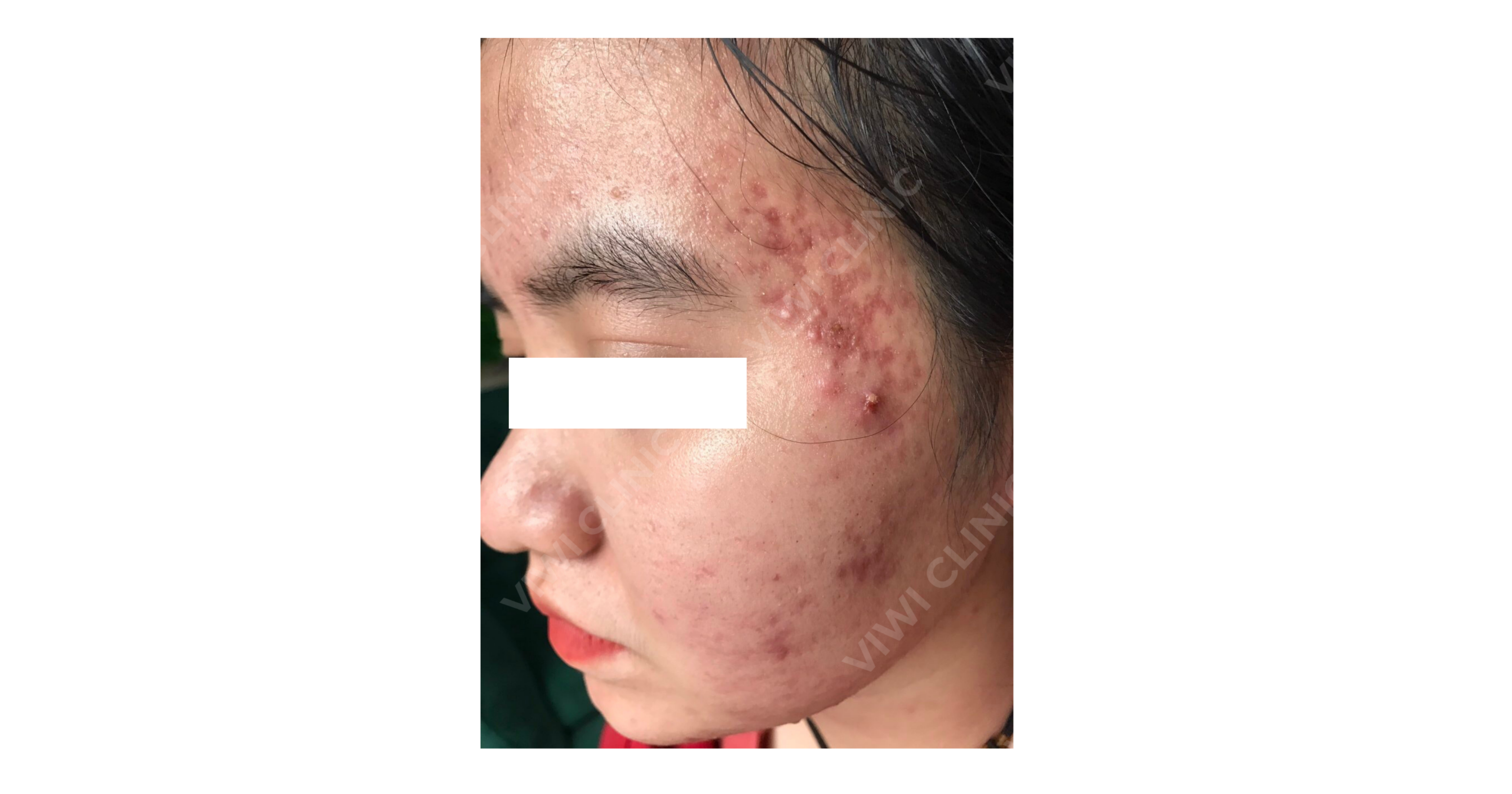 Trị thâm sau mụn nhanh cho da bị sạm lâu ngày