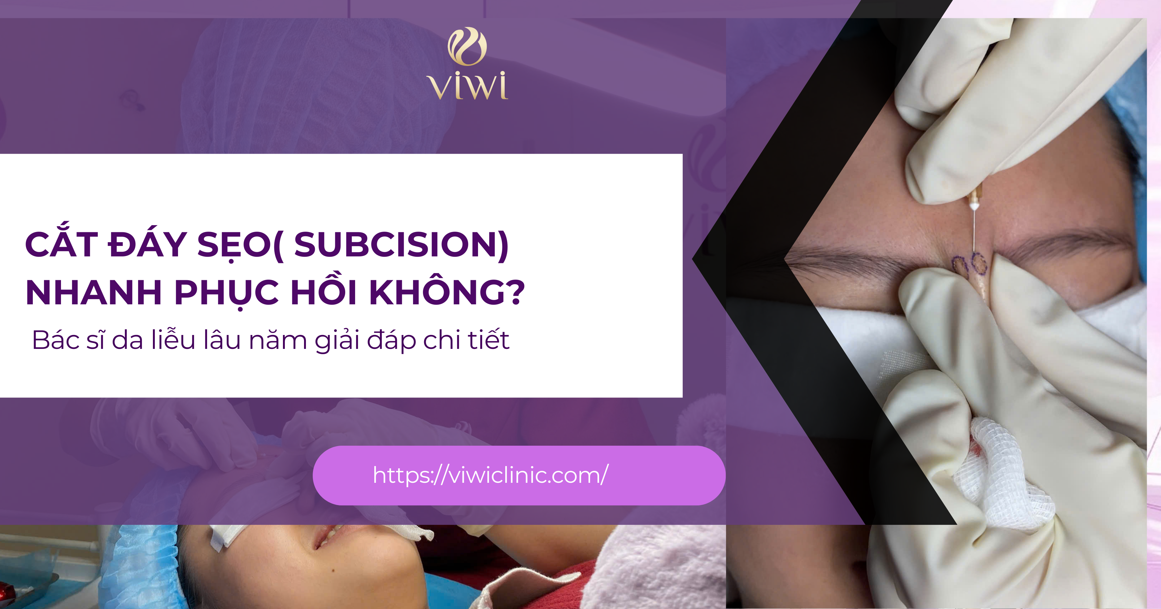 Cắt đáy sẹo( subcision) nhanh phục hồi không