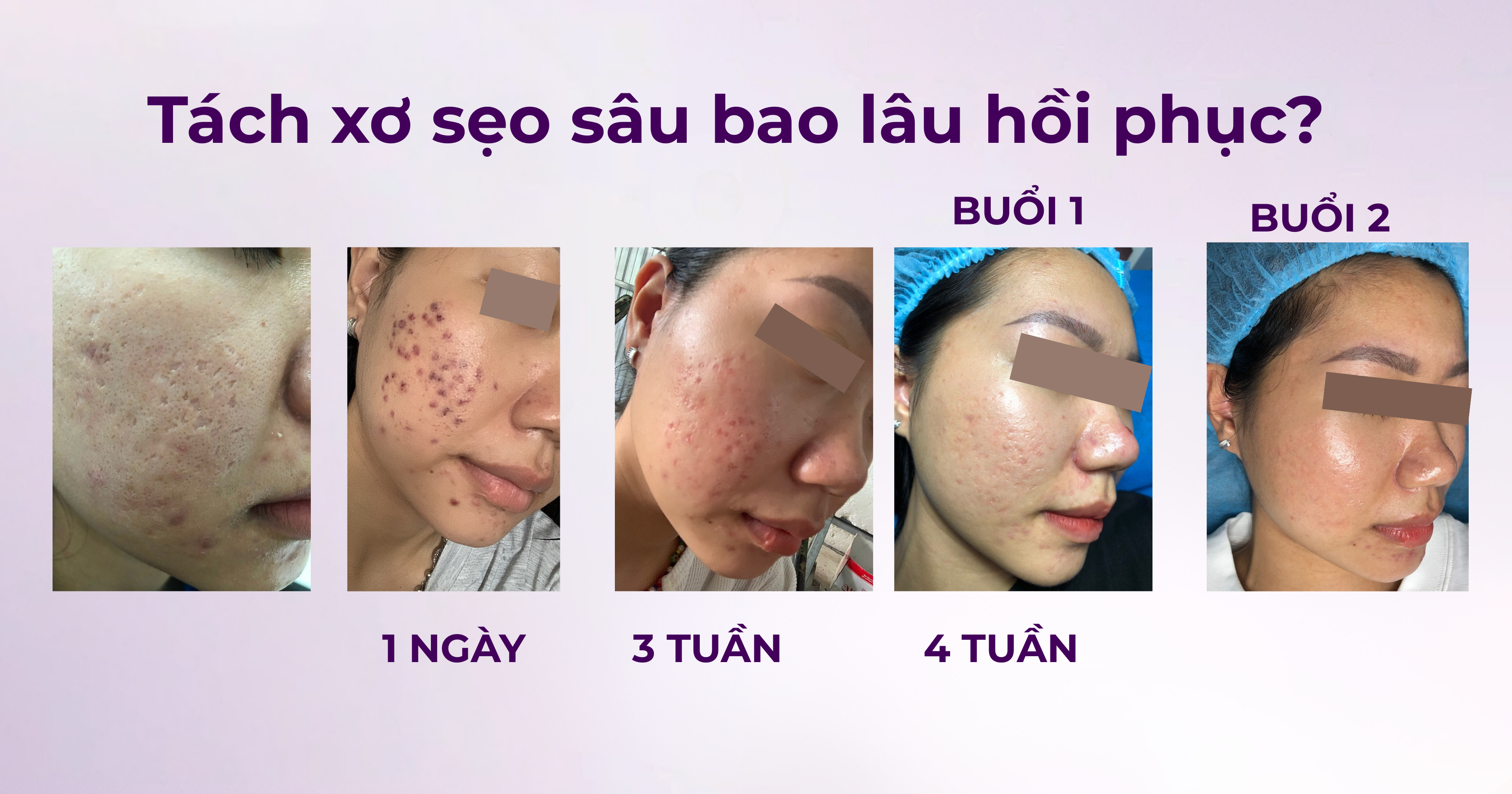 Tách xơ sẹo sâu bao lâu hồi phục có để lại bầm không
