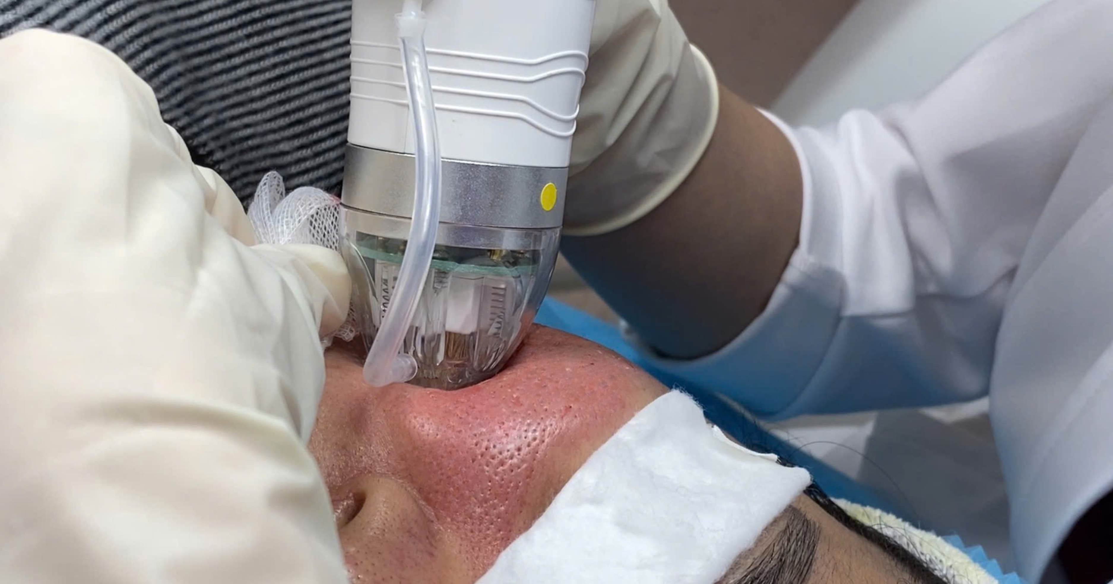 RF Needle có đau không và có bị thâm không?